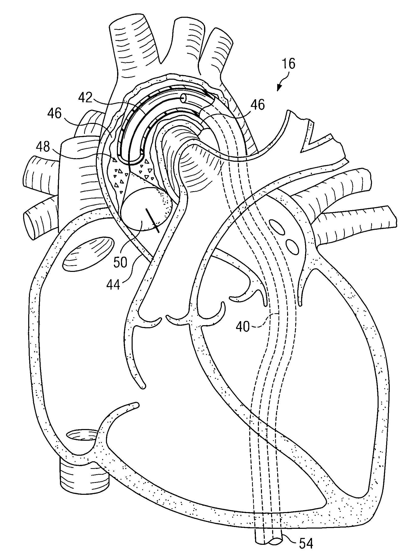 System and method for providing embolic protection