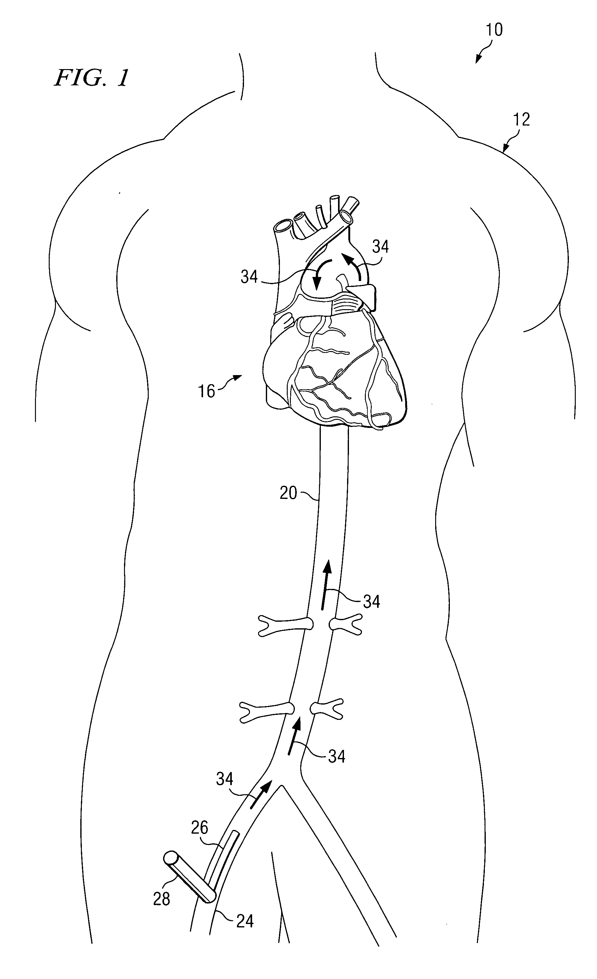 System and method for providing embolic protection