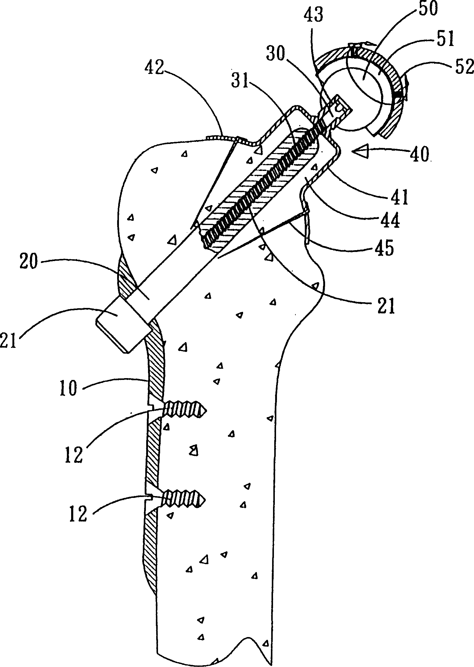 Artificial hip joint device without handle