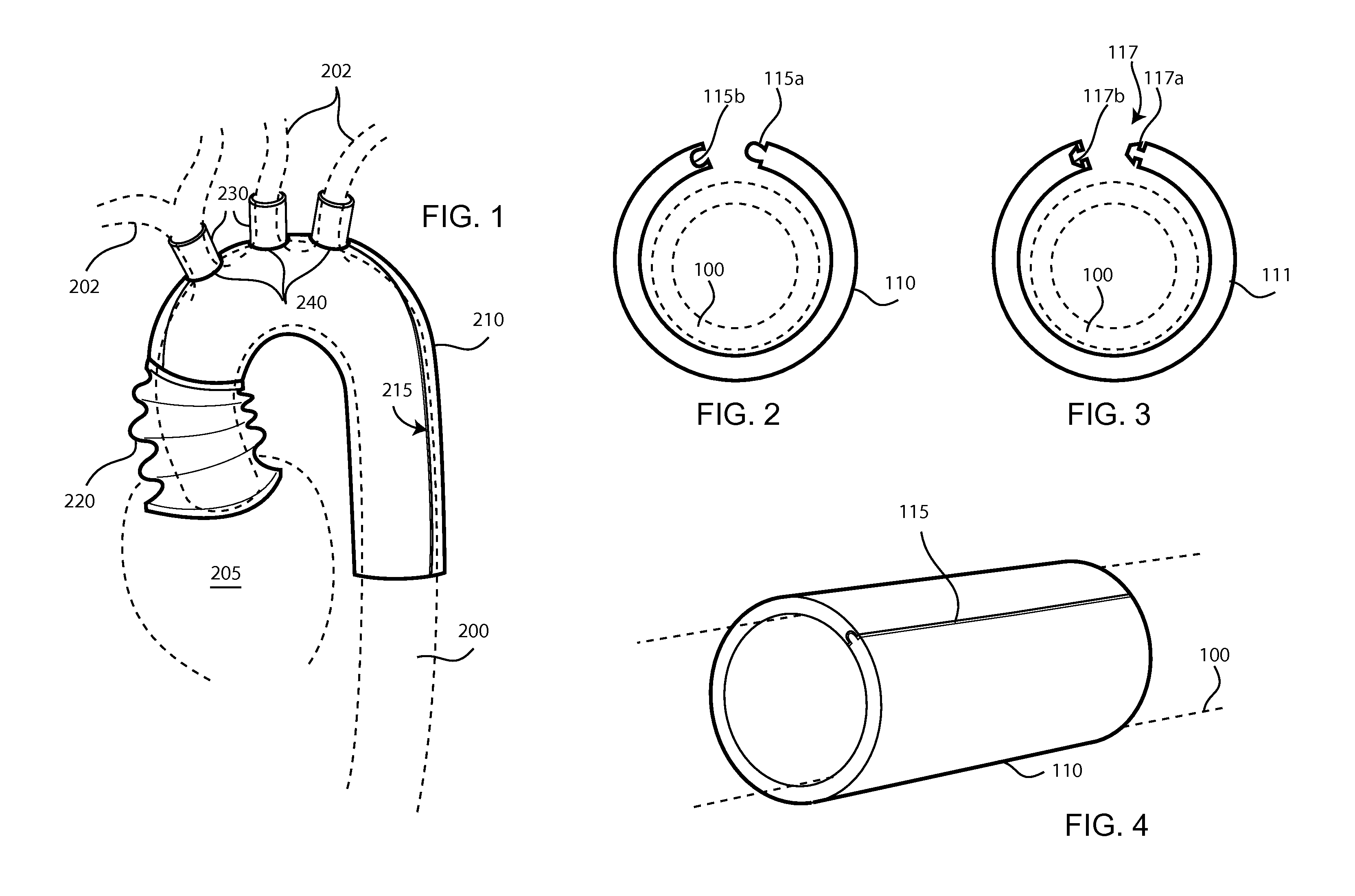 Method for deploying a sleeve and tubing device for restricting and constricting aneurysms and a sleeve and tubing device and system