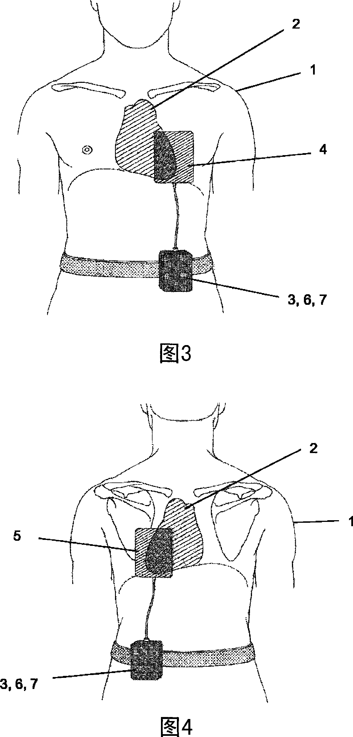 Electromedical implantable or extracorporeally applicable device for the treatment or monitoring of organs, and method for therapeutic organ treatment