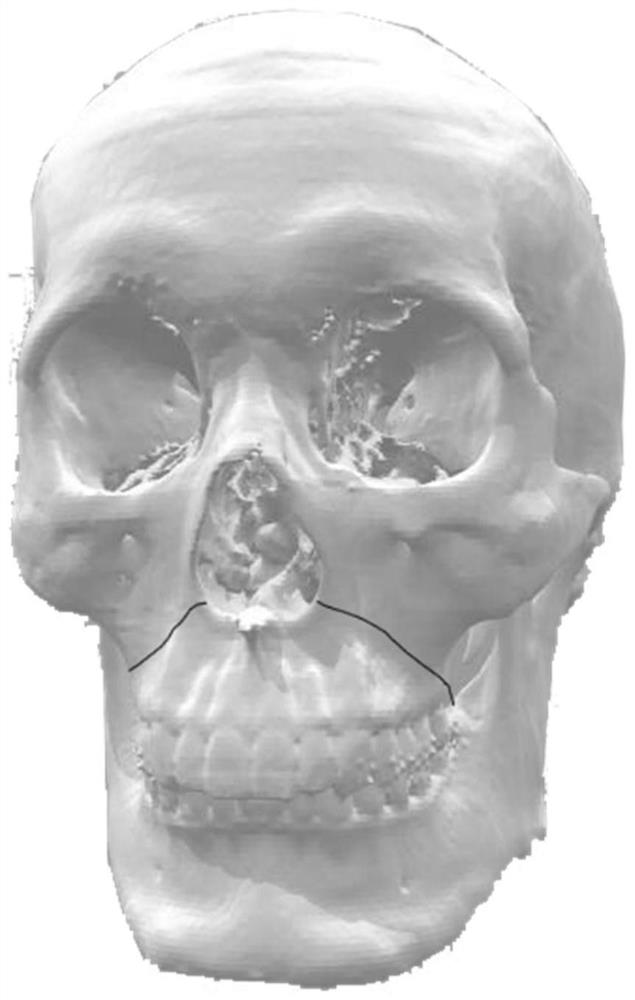 A calibration device for real-time tracking of the position of free bone fragments