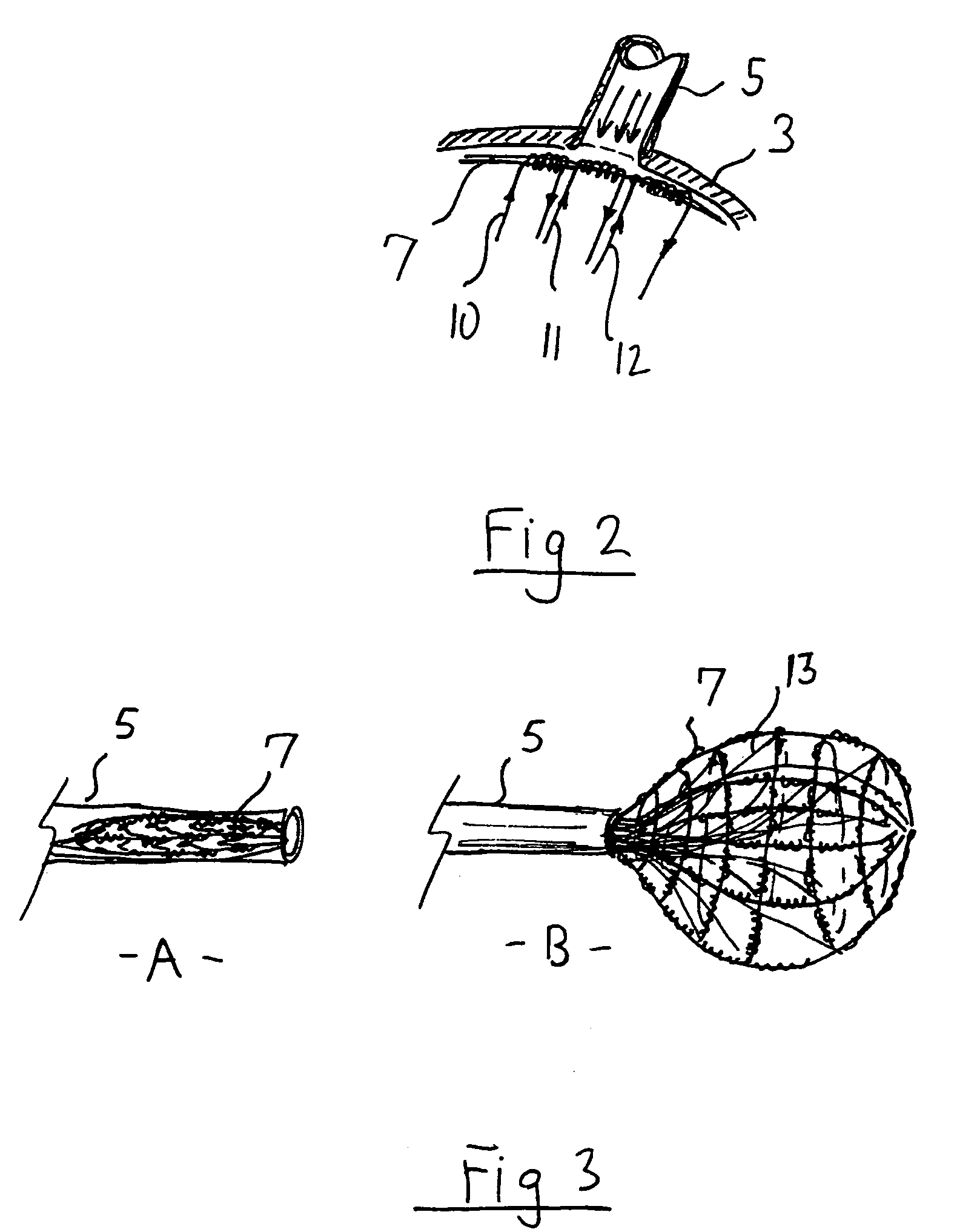 Intra-cardiac mapping and ablation method