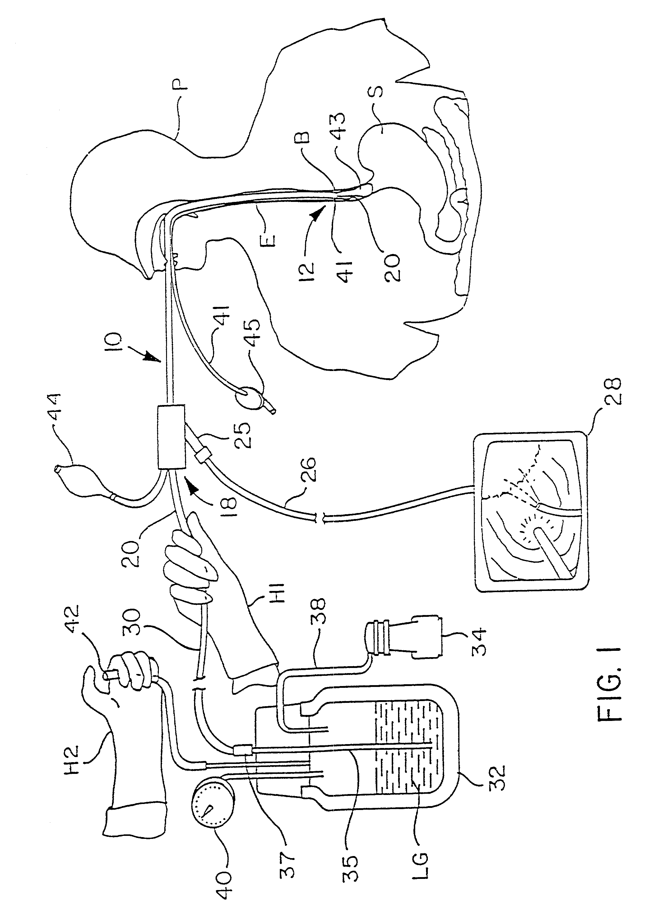 Method and apparatus for cryogenic spray ablation of gastrointestinal mucosa