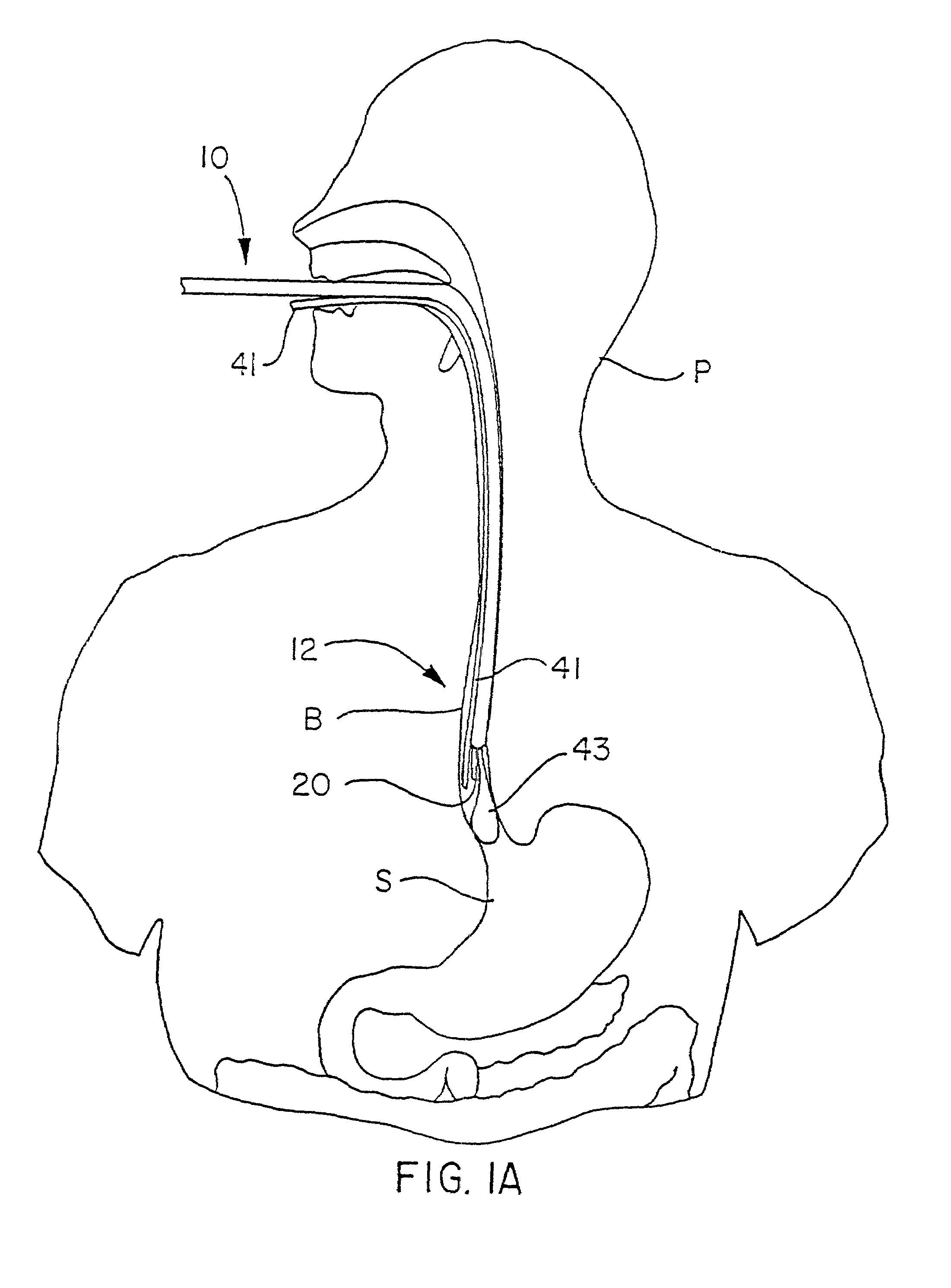 Method and apparatus for cryogenic spray ablation of gastrointestinal mucosa