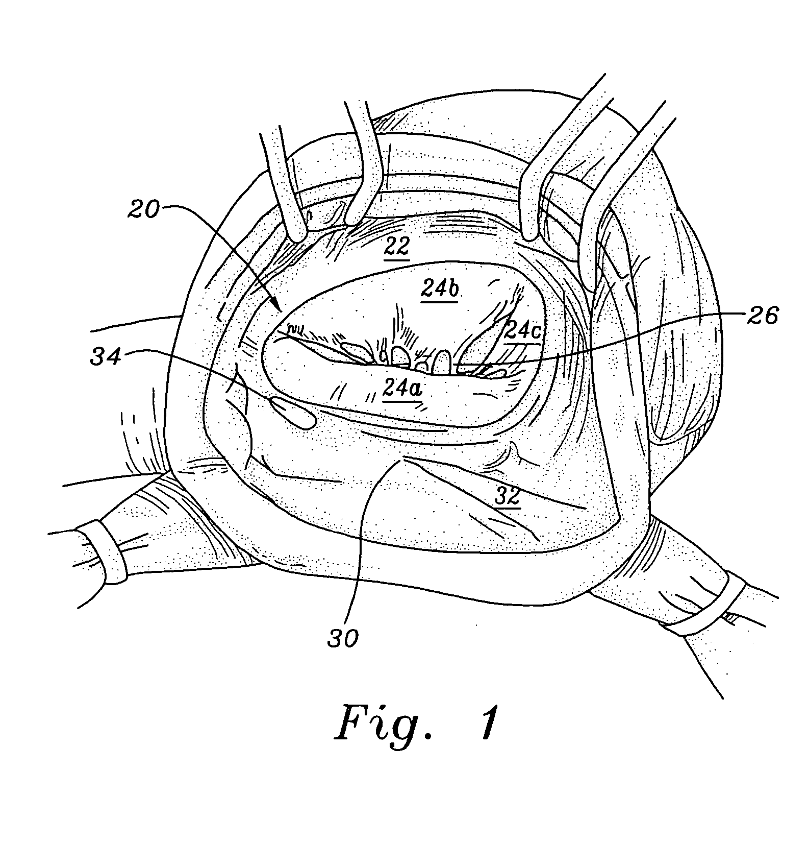 Three-dimensional annuloplasty ring and template