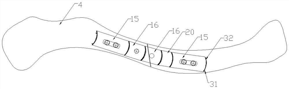 Assembled and adjustable clavicle fixing device with reduction function and use method of assembled and adjustable clavicle fixing device