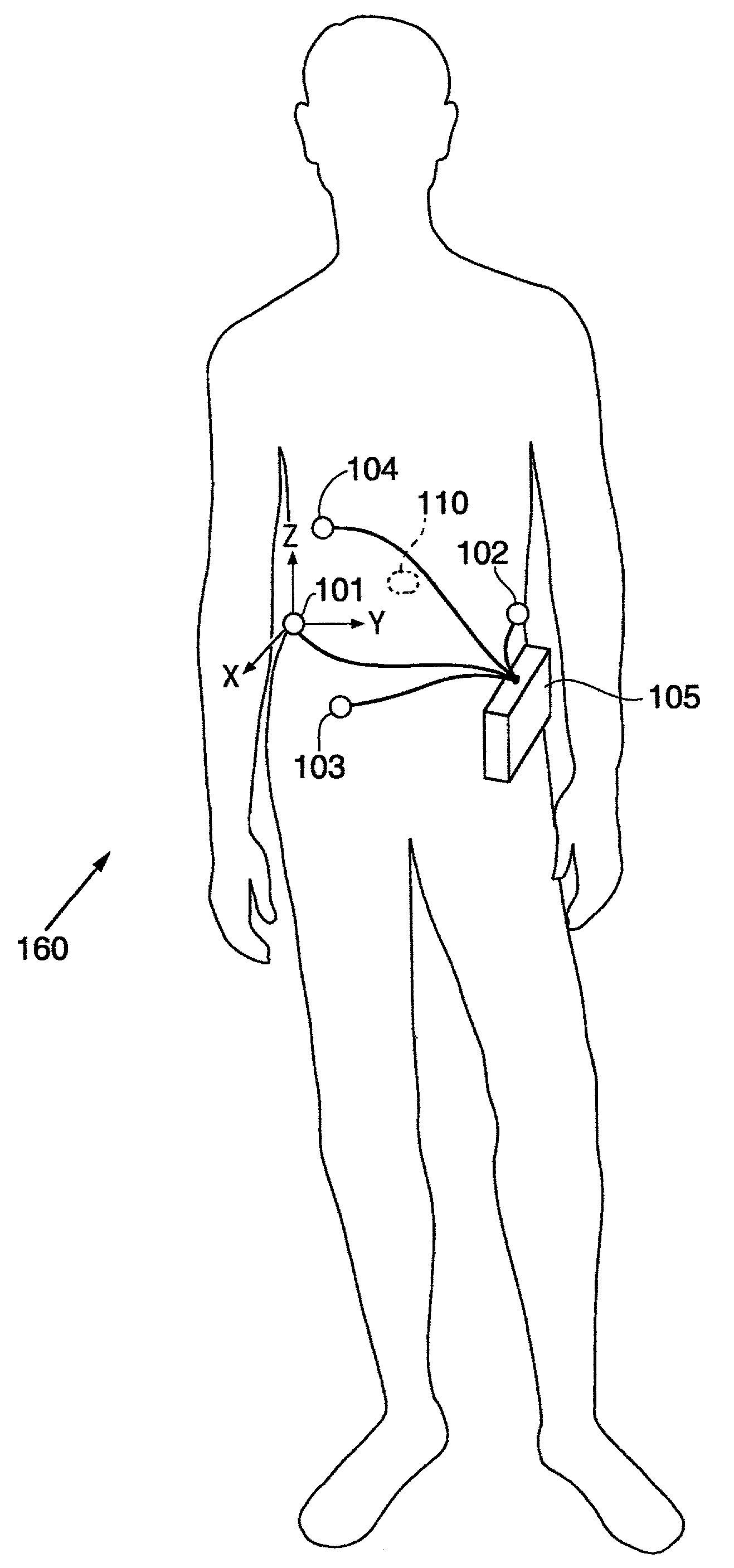 Capsule and method for treating or diagnosing the intestinal tract