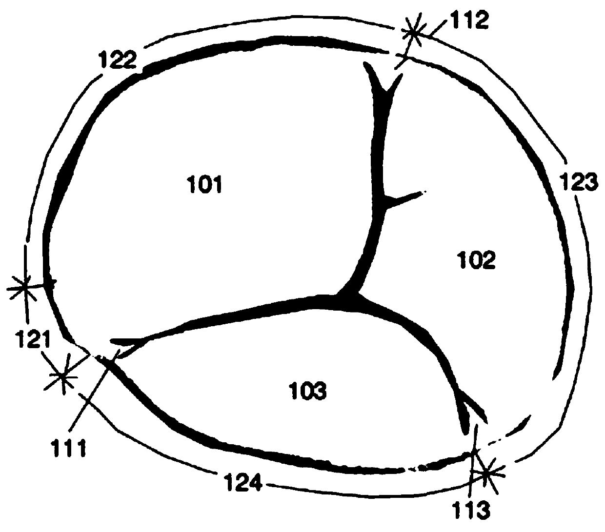 Tricuspid valvuloplasty ring