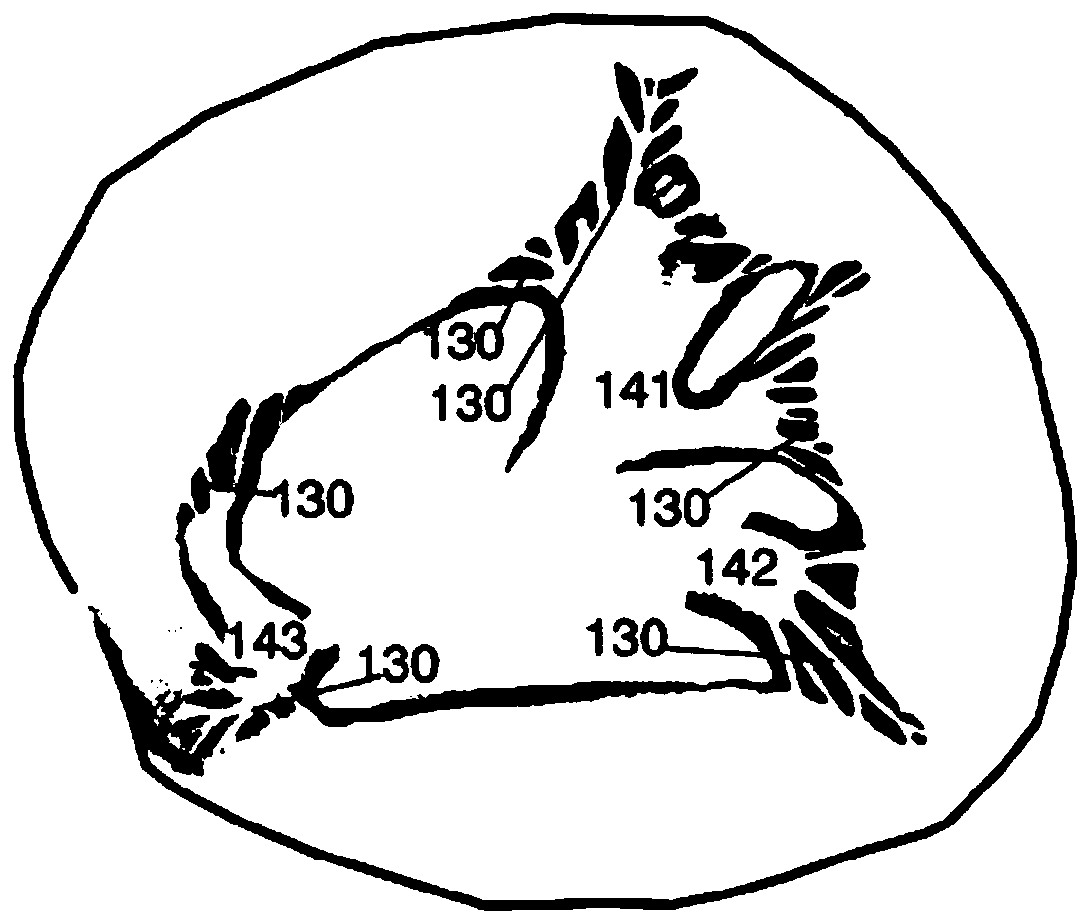 Tricuspid valvuloplasty ring