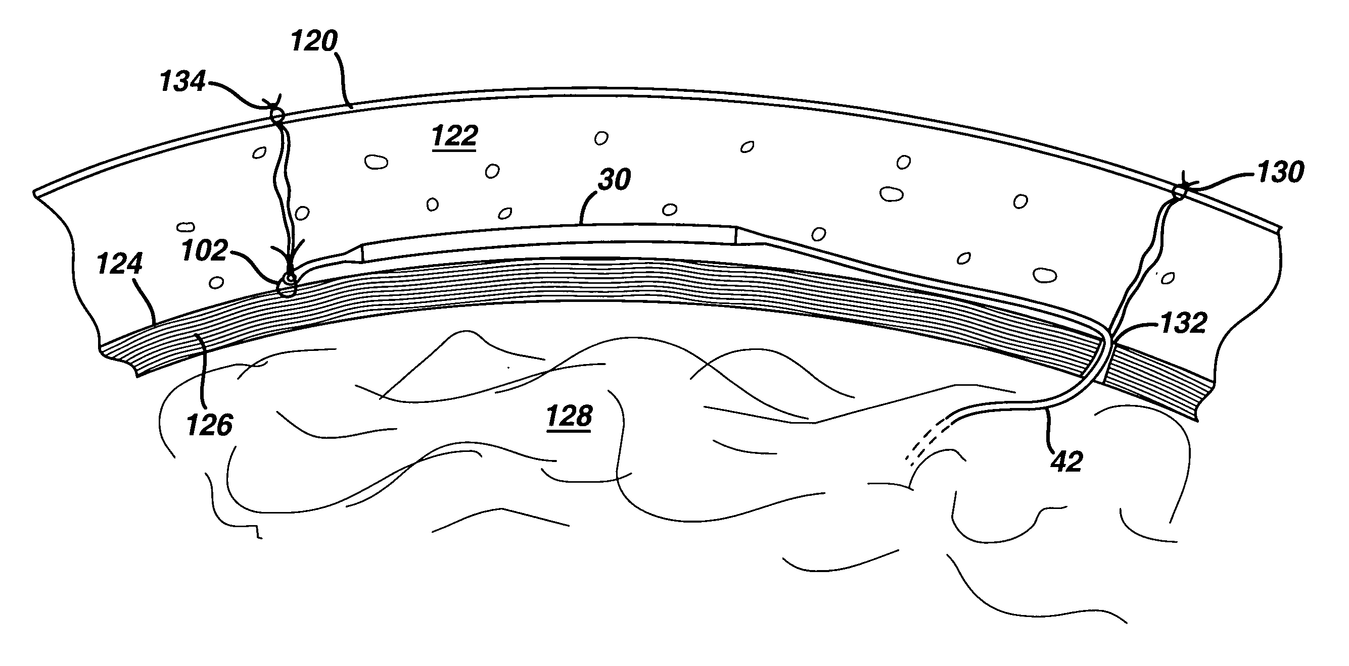 Method for implanting flexible injection port