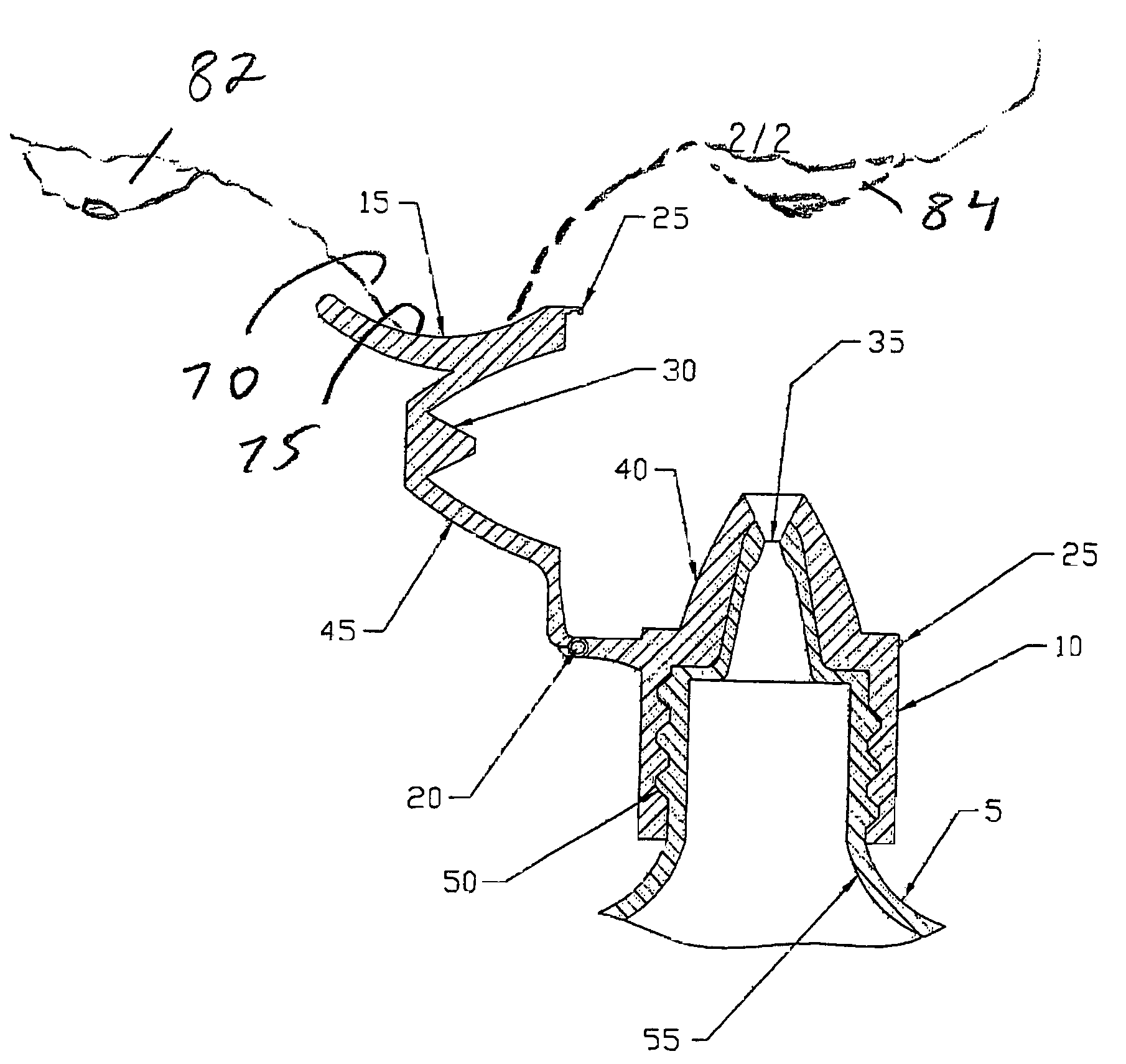 Ocular positioning droplet dispensing device with a recessed dispensing orifice