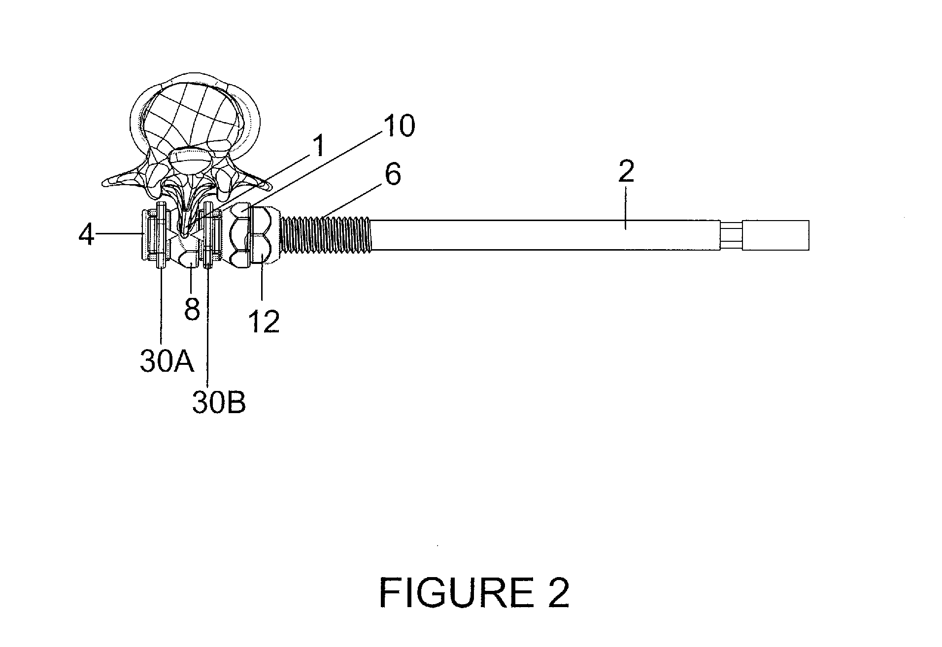 Spinous process fixation plate and minimally invasive method for placement