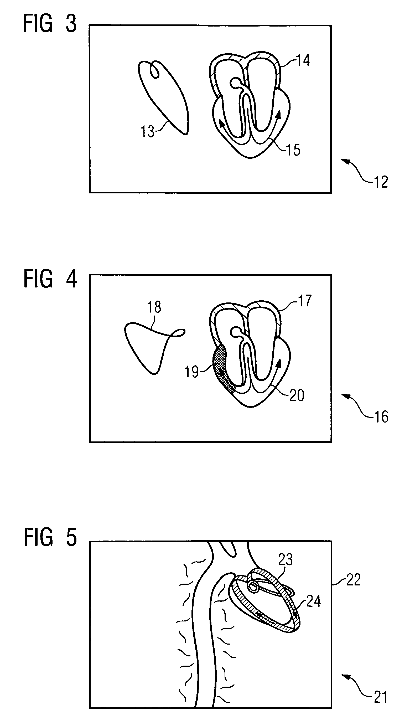 Method for determining cardiac impulse conduction and associated medical device