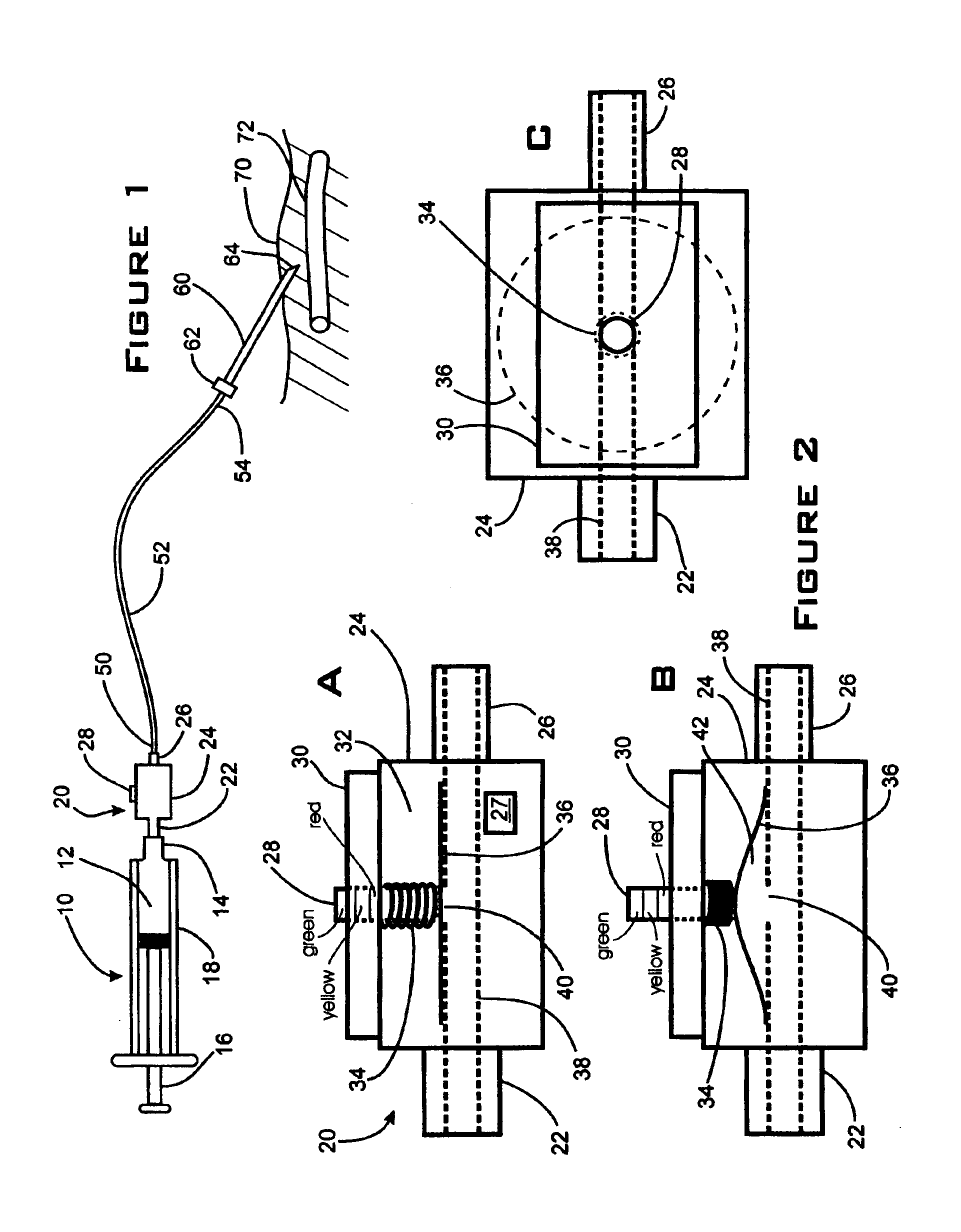 Method and apparatus to decrease the risk of intraneuronal injection during administration of nerve block anesthesia