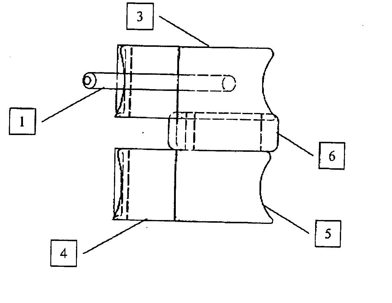 Transosseous spine core approach method implant and instrumentation