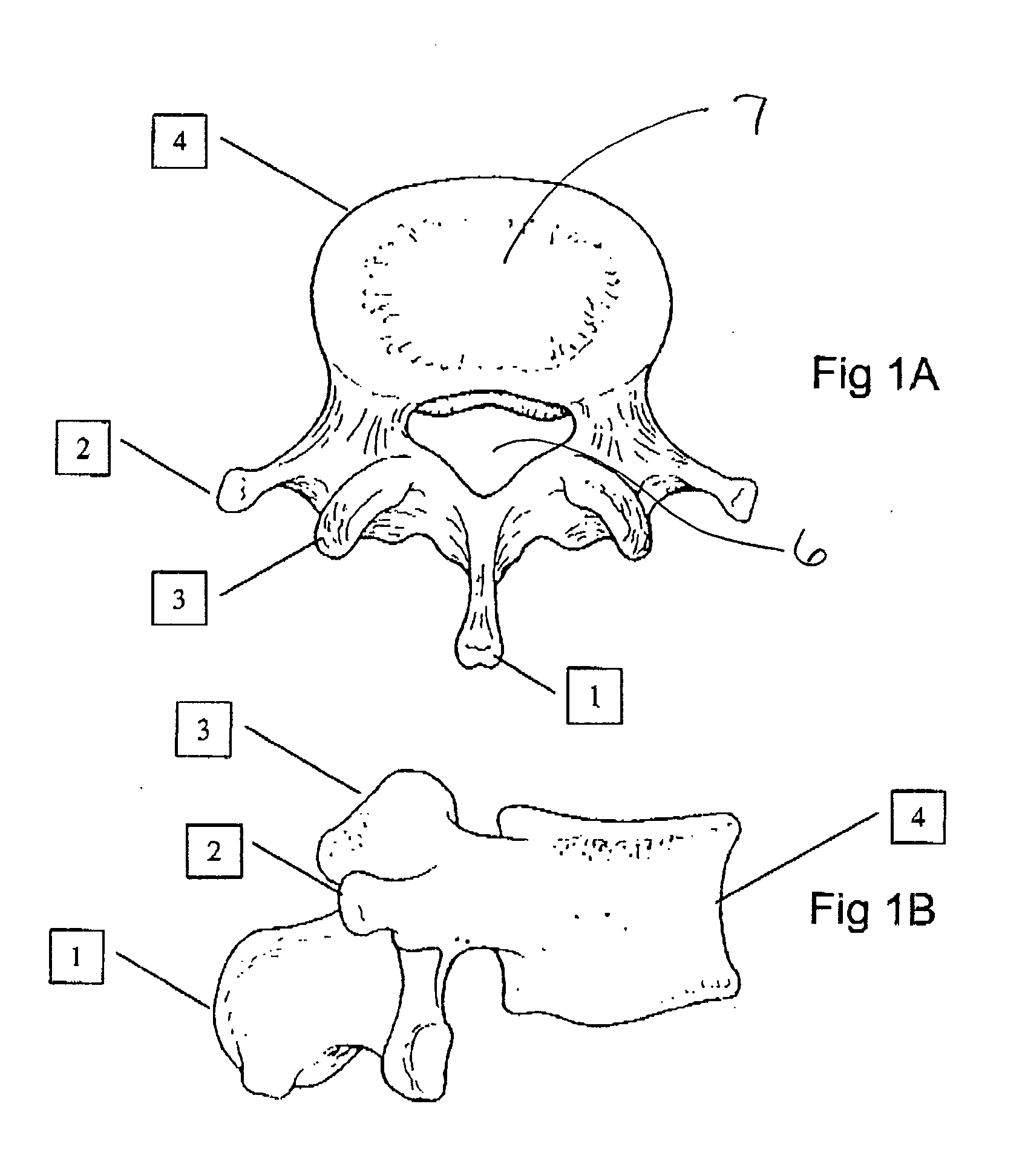 Transosseous spine core approach method implant and instrumentation