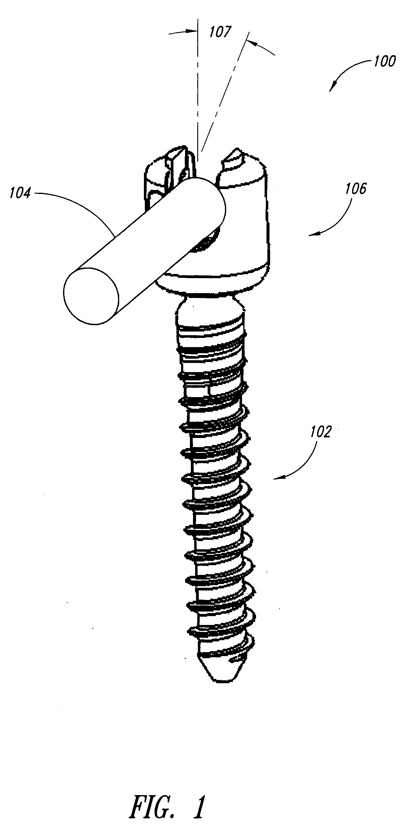 Pedicle screw systems and methods of assembling/installing the same