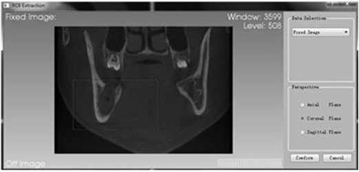 An Osteomyelitis Lesion Analysis Method Based on Medical Image Registration