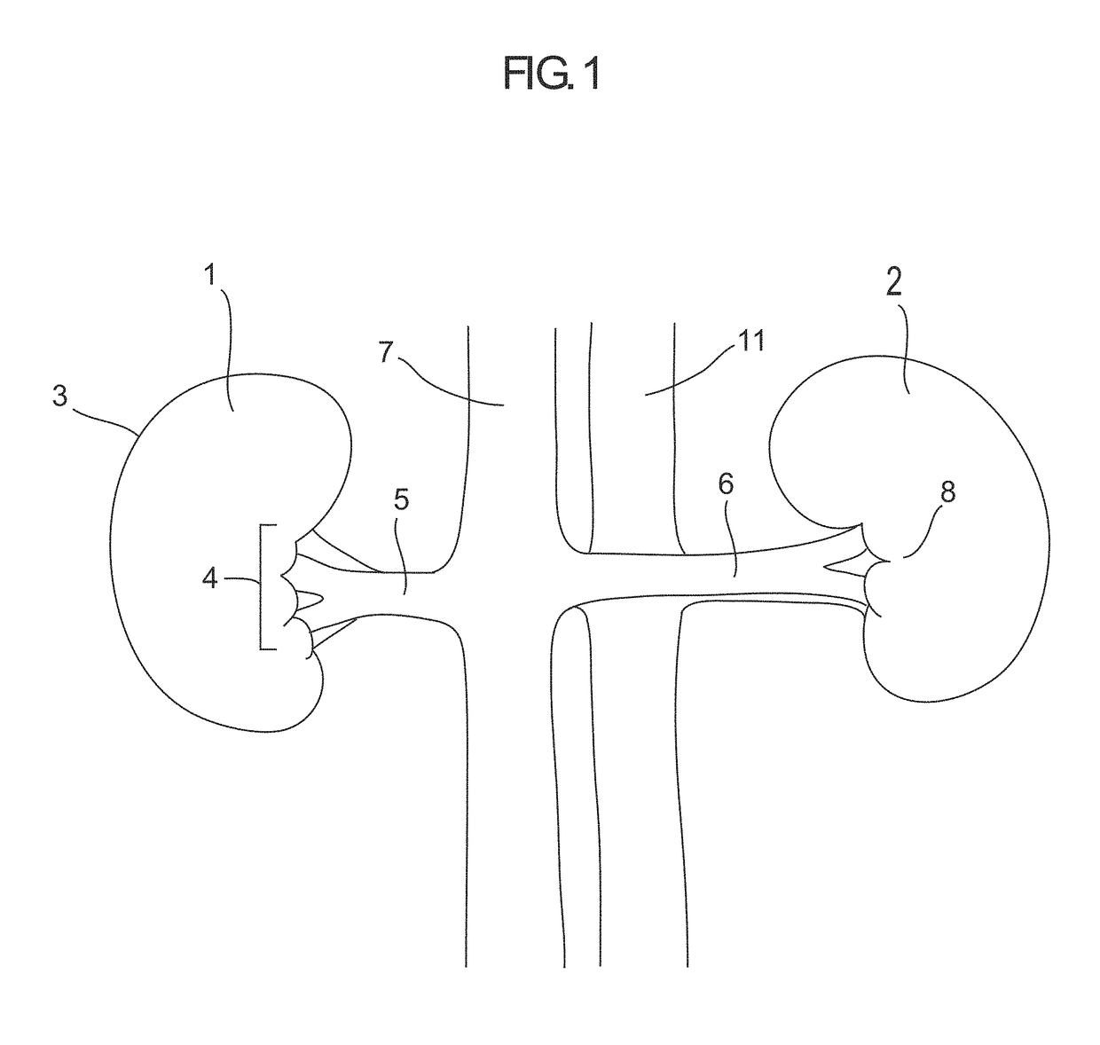 Devices and methods for detection and treatment of the aorticorenal ganglion