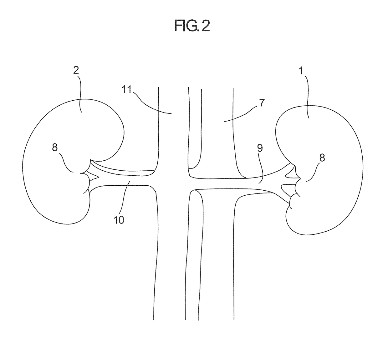 Devices and methods for detection and treatment of the aorticorenal ganglion