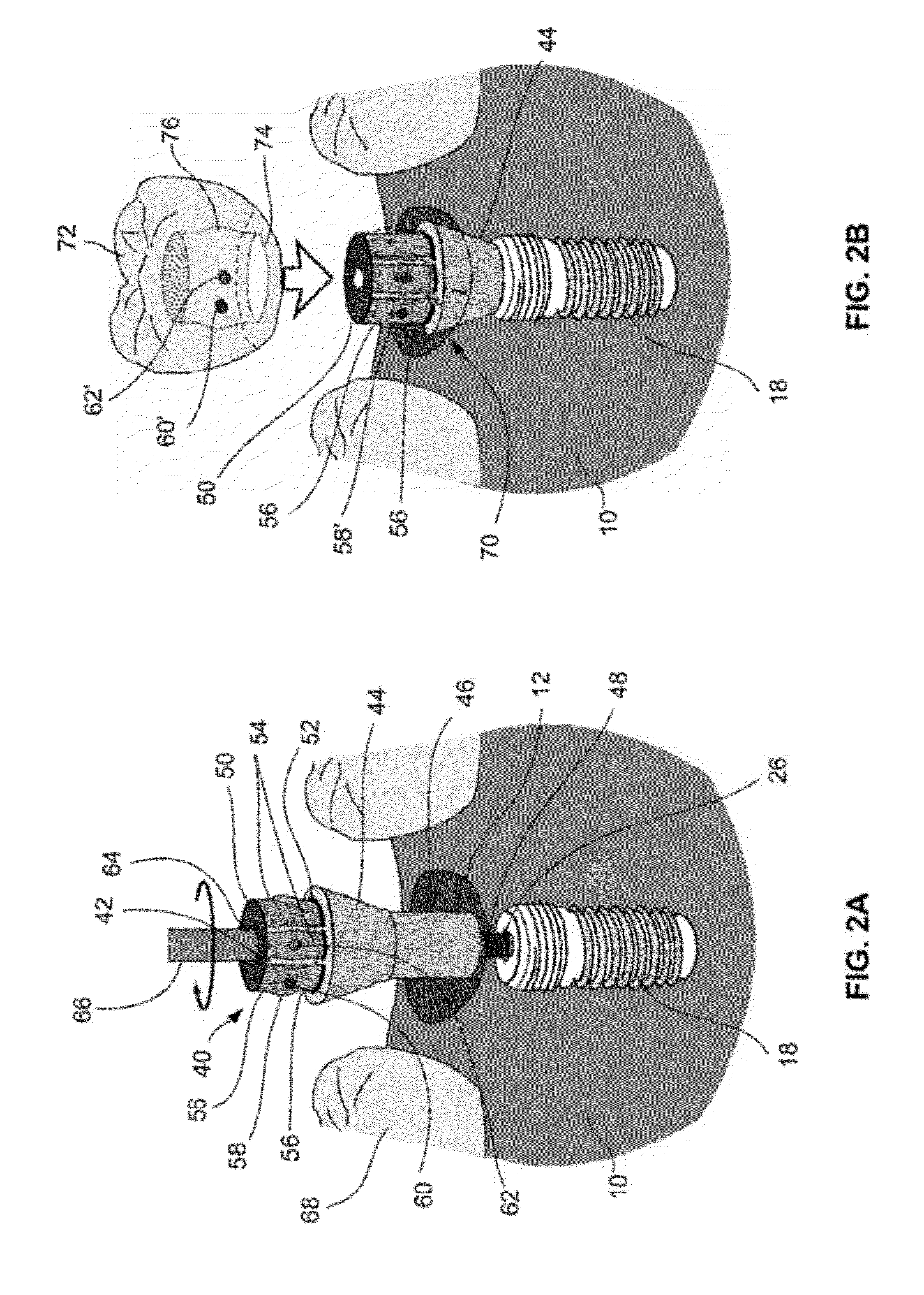 Abutment devices and methods for natural teeth