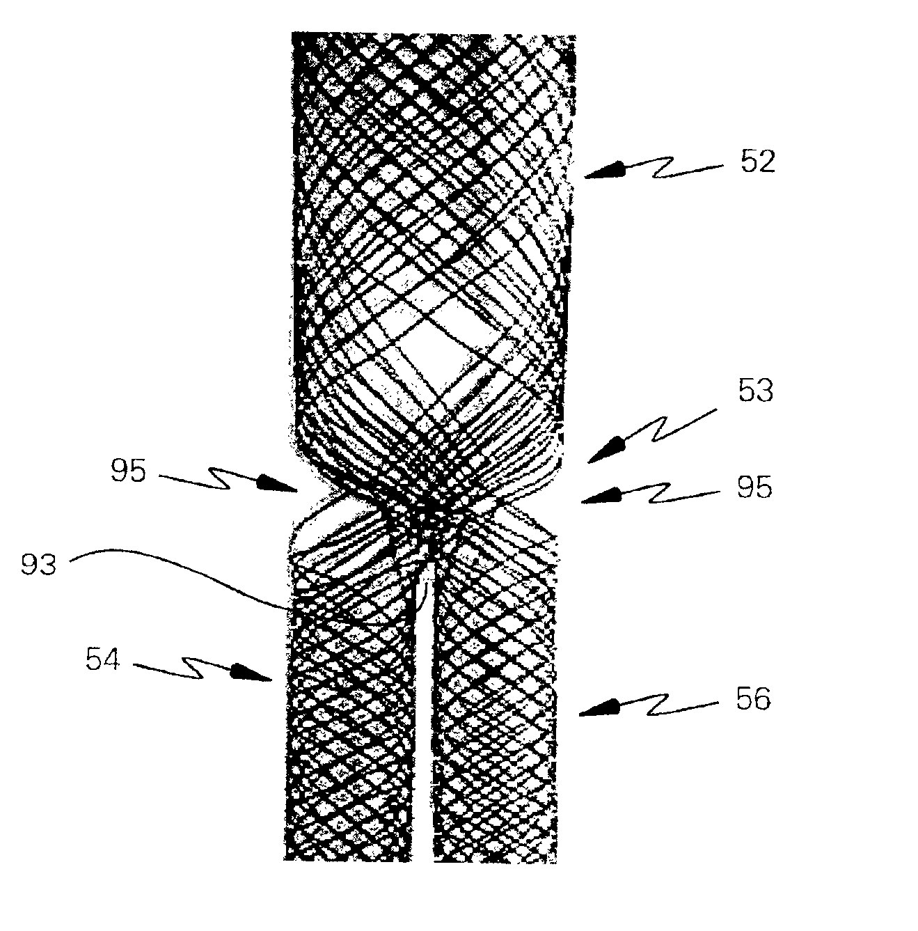 Braided branching stent, method for treating a lumen therewith, and process for manufacture thereof