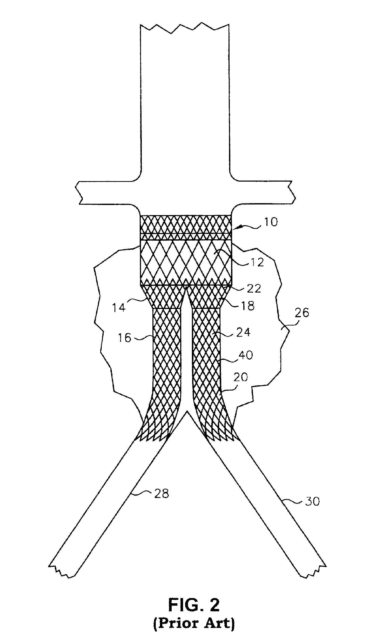 Braided branching stent, method for treating a lumen therewith, and process for manufacture thereof