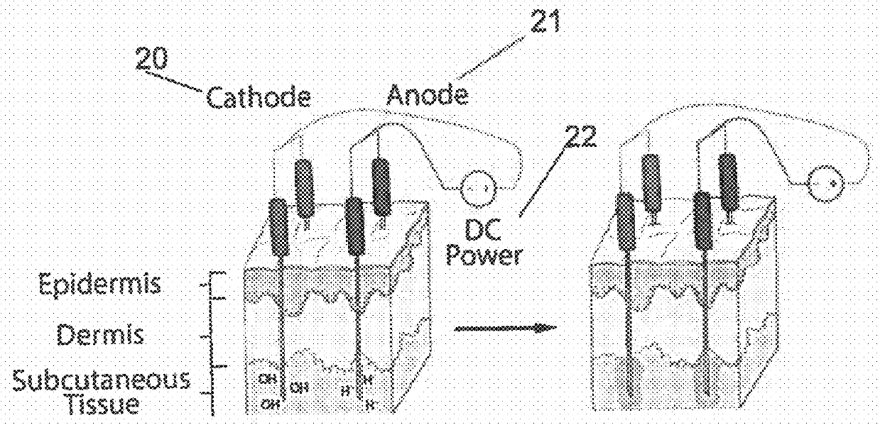 Method and device for electrochemical therapy of skin and related soft tissues