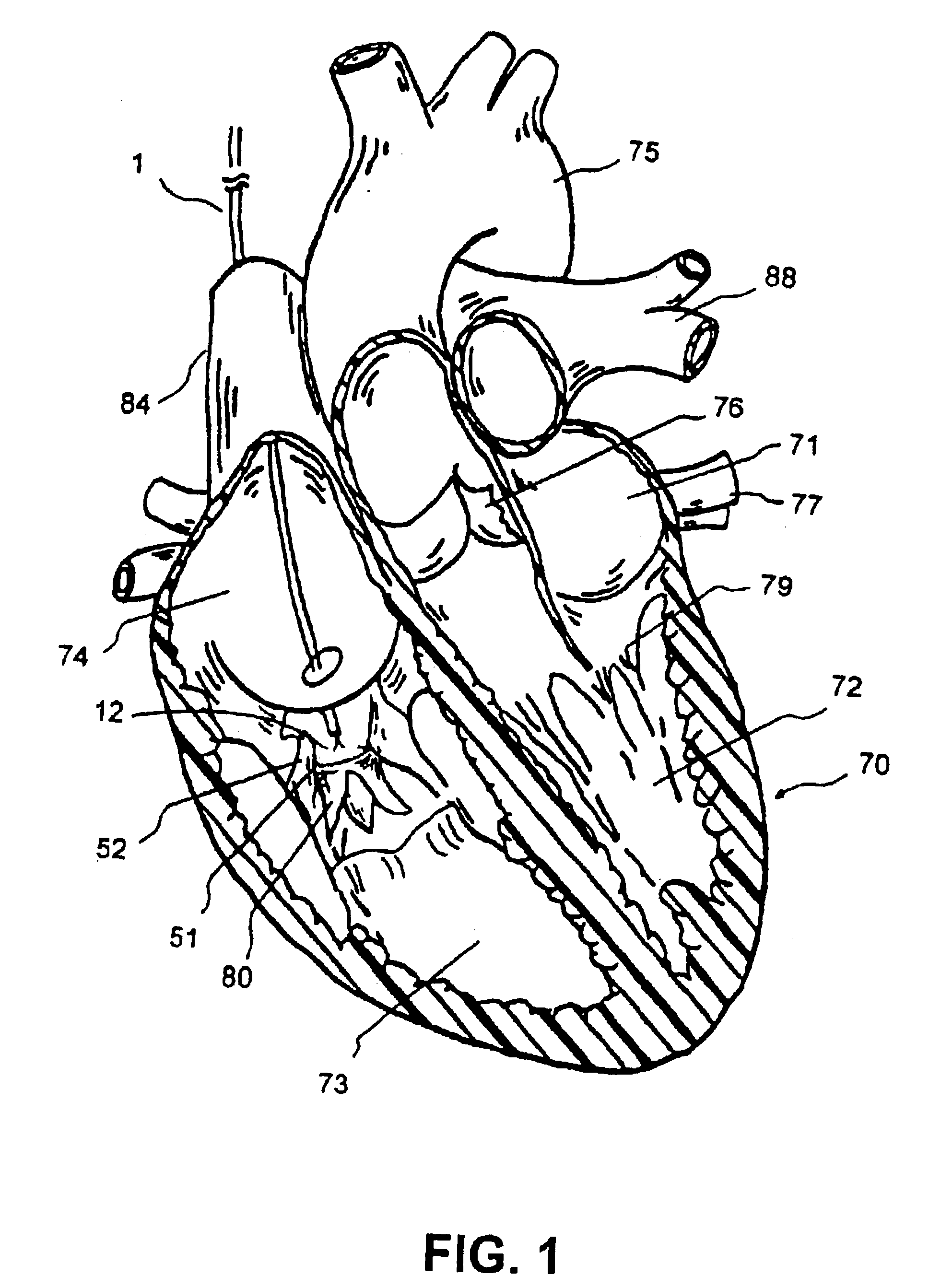 Cardiac valve leaflet attachment device and methods thereof