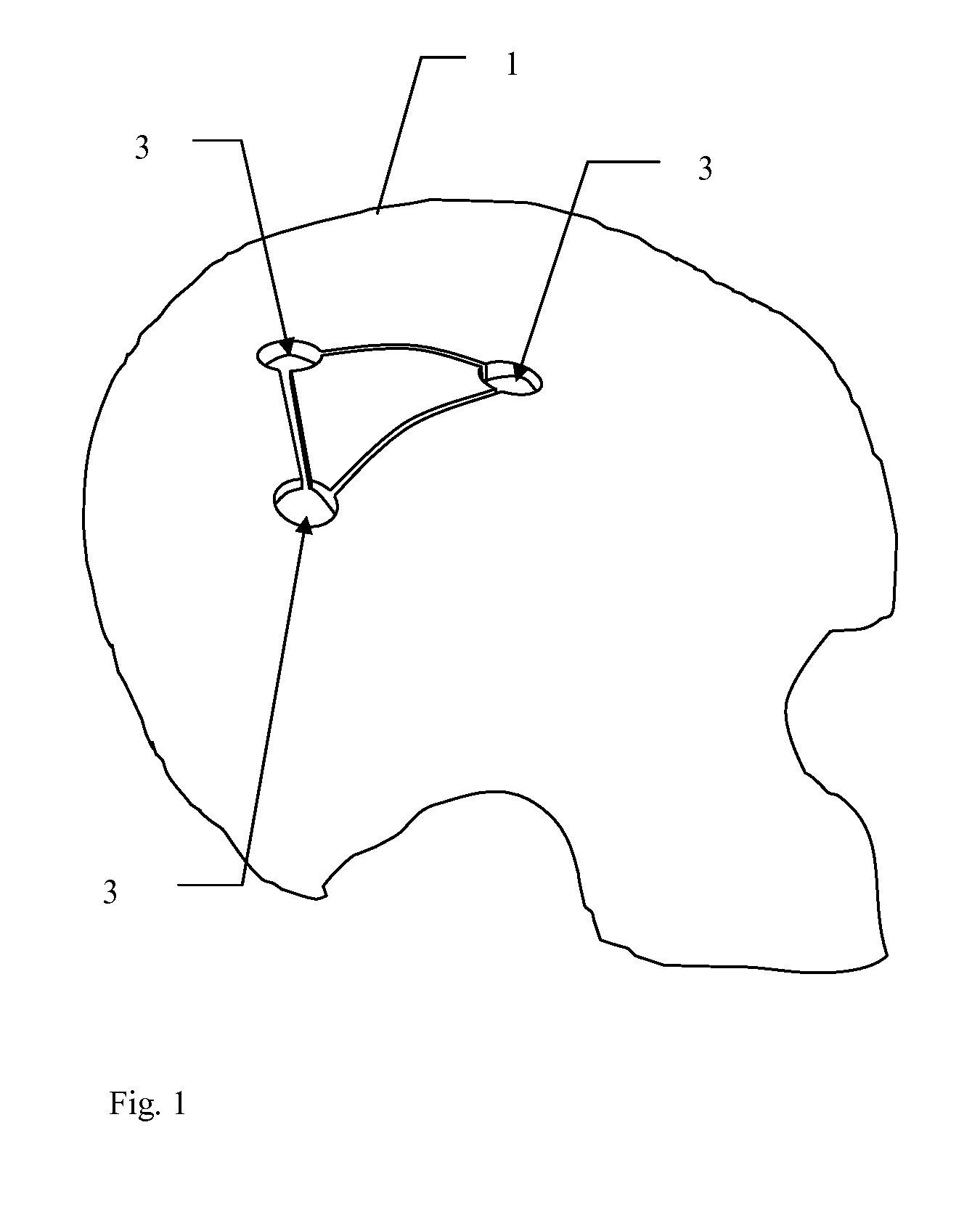 Implants and methods for using such implants to fill holes in bone tissue