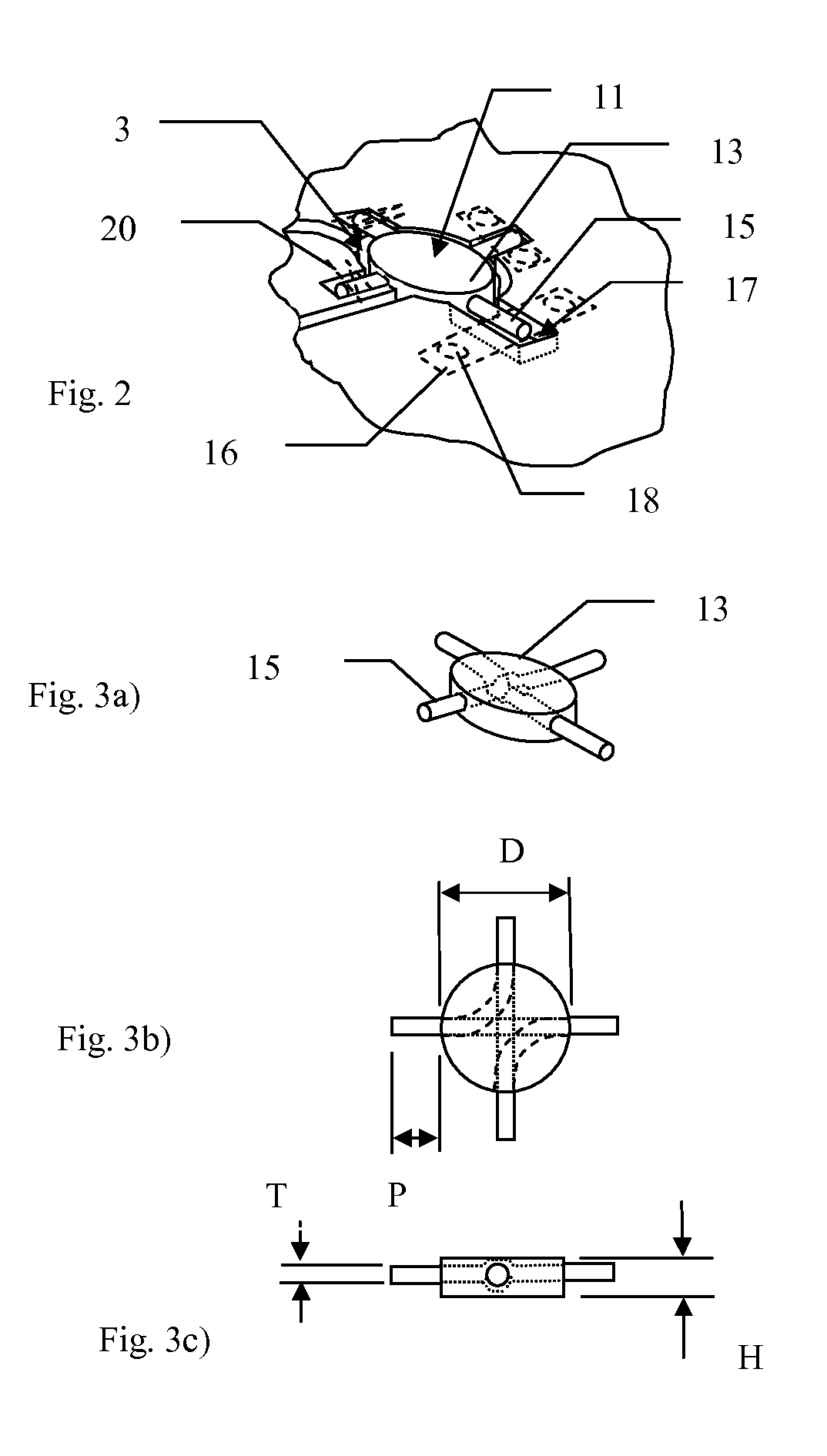 Implants and methods for using such implants to fill holes in bone tissue