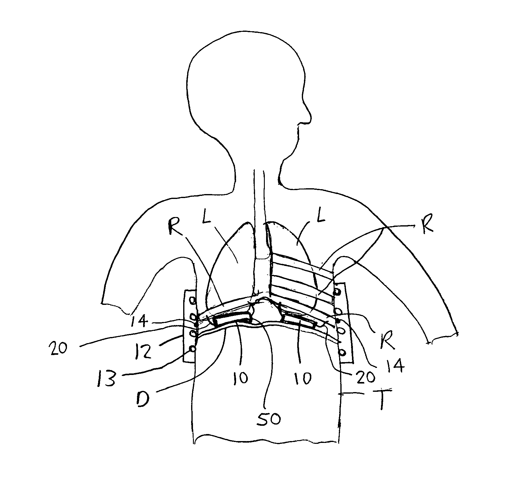 Electromagnetic diaphragm assist device and method for assisting a diaphragm function