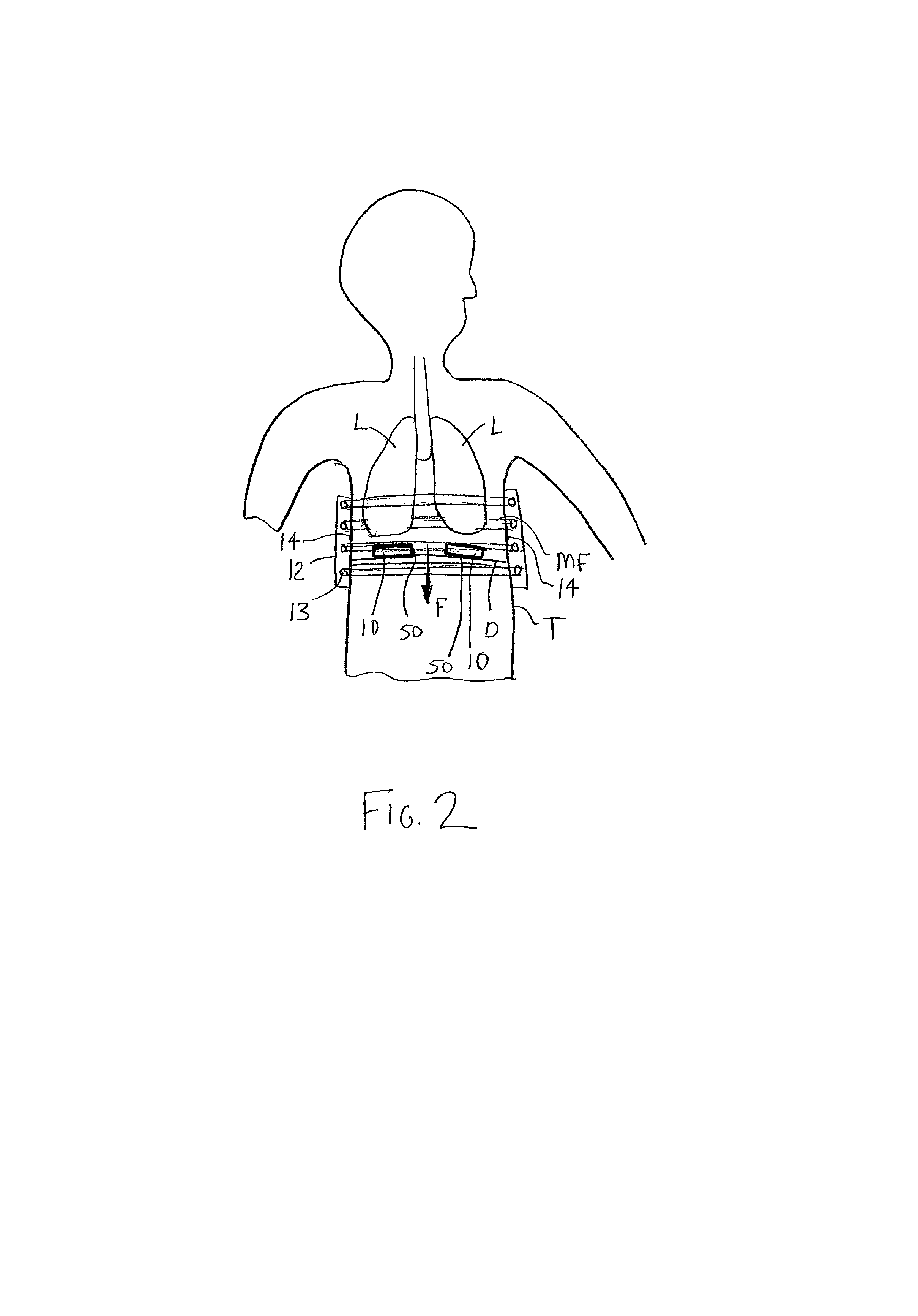 Electromagnetic diaphragm assist device and method for assisting a diaphragm function