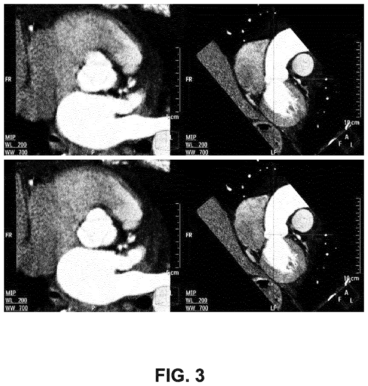 Motion compensated cardiac valve reconstruction