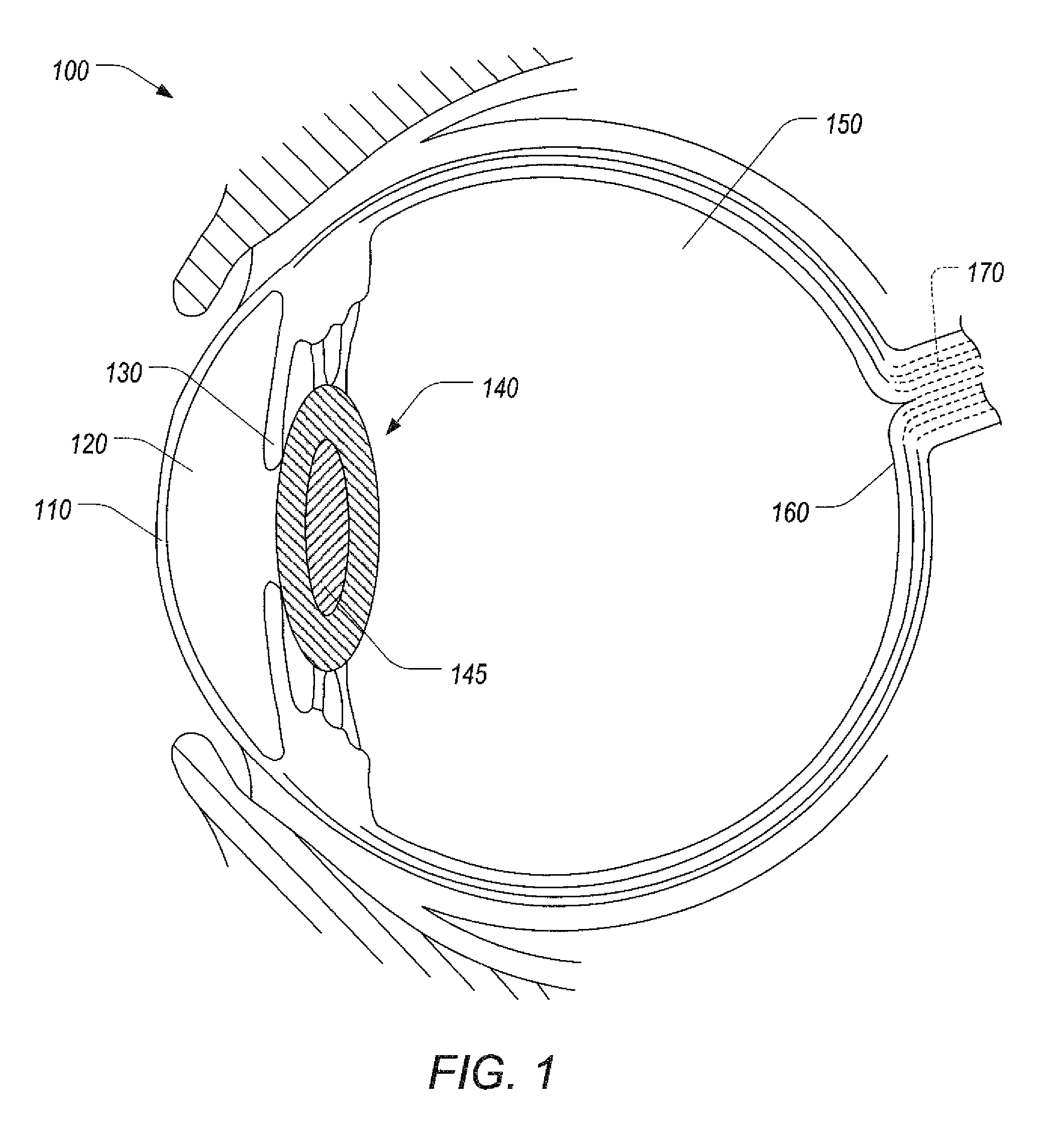 Varying a numerical aperture of a laser during lens fragmentation in cataract surgery