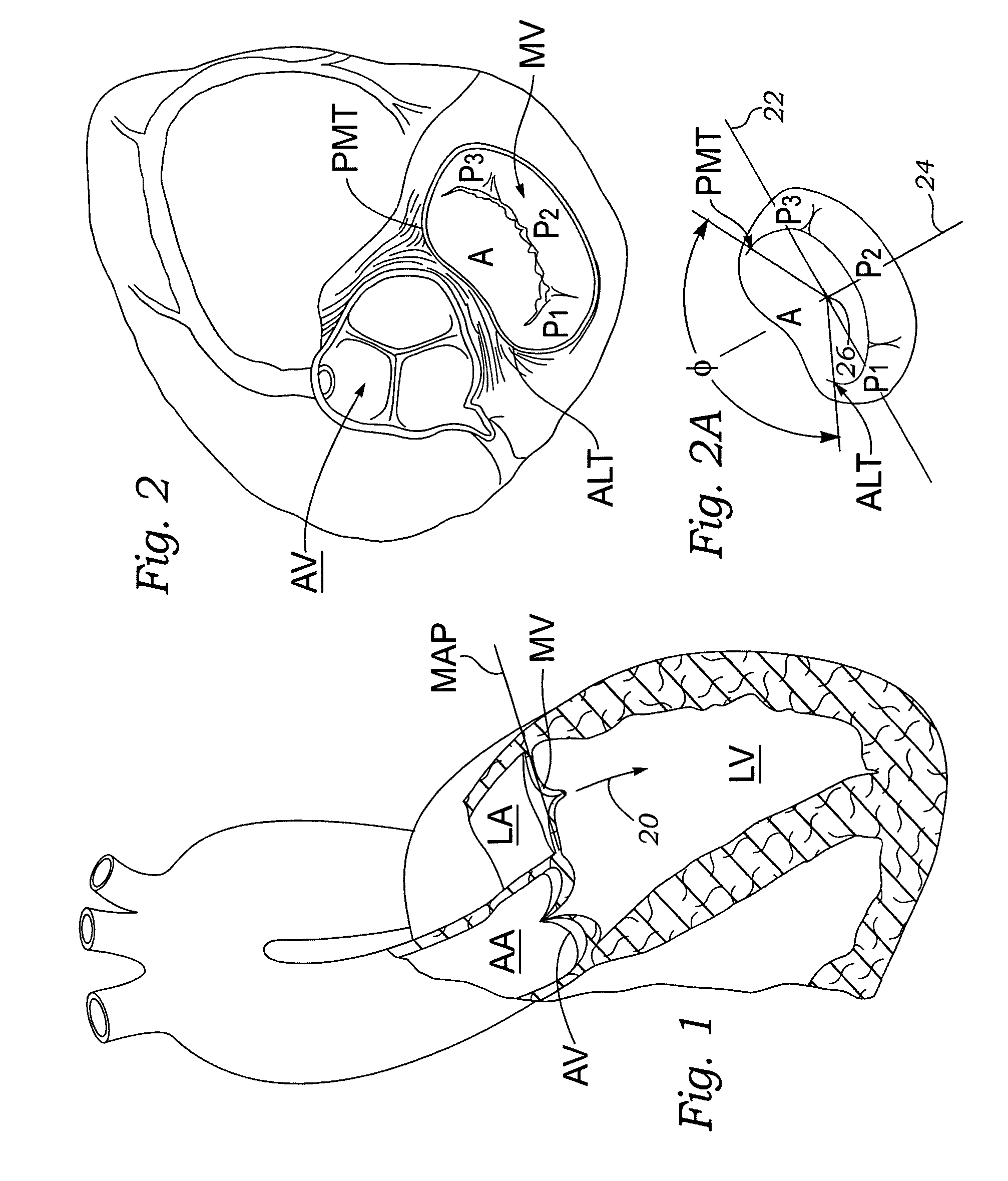 Methods of implanting a prosthetic mitral heart valve having a contoured sewing ring