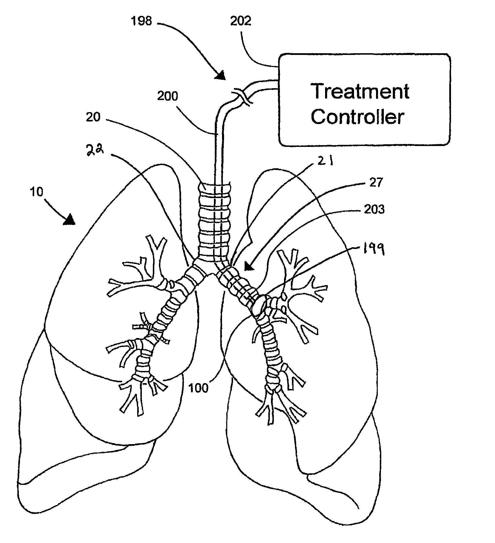Systems, assemblies, and methods for treating a bronchial tree