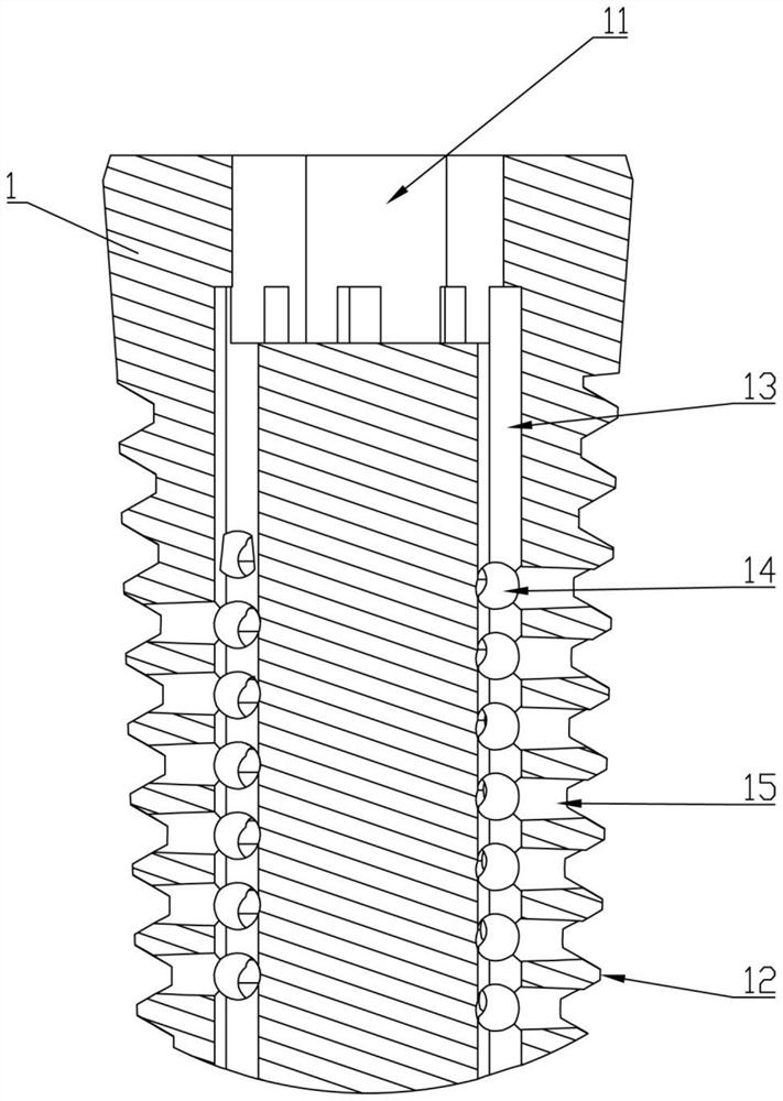 Composite dental implant and preparation method thereof