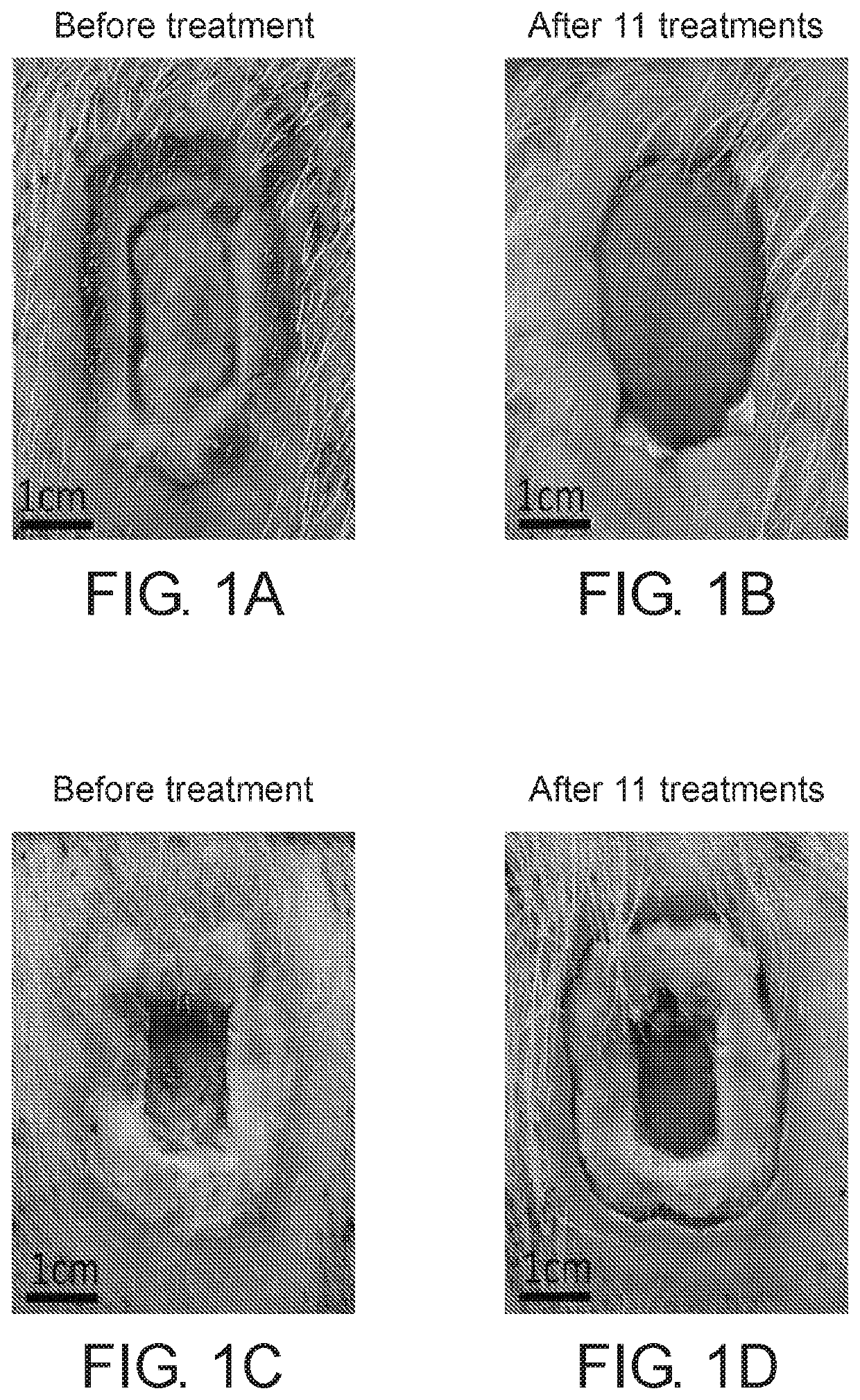 Debriding composition for treating wounds