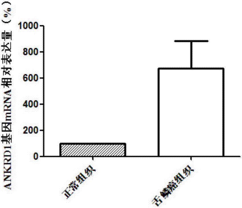 ANKRD1 as diagnosis and treatment target of tongue squamous cell carcinoma