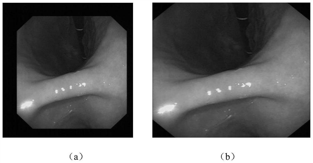Gastrointestinal endoscope image anomaly detection method based on local feature and class label embedding constraint dictionary learning