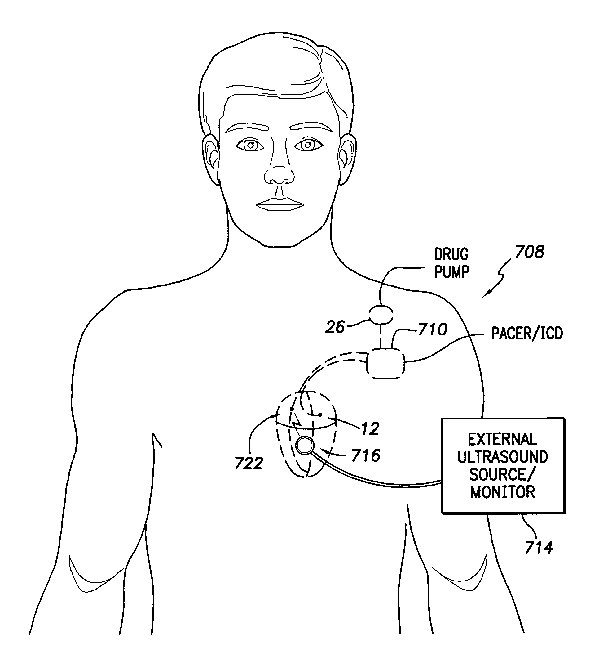 System and method for measuring cardiac output via thermal dilution using an implantable medical device with an external ultrasound power delivery system