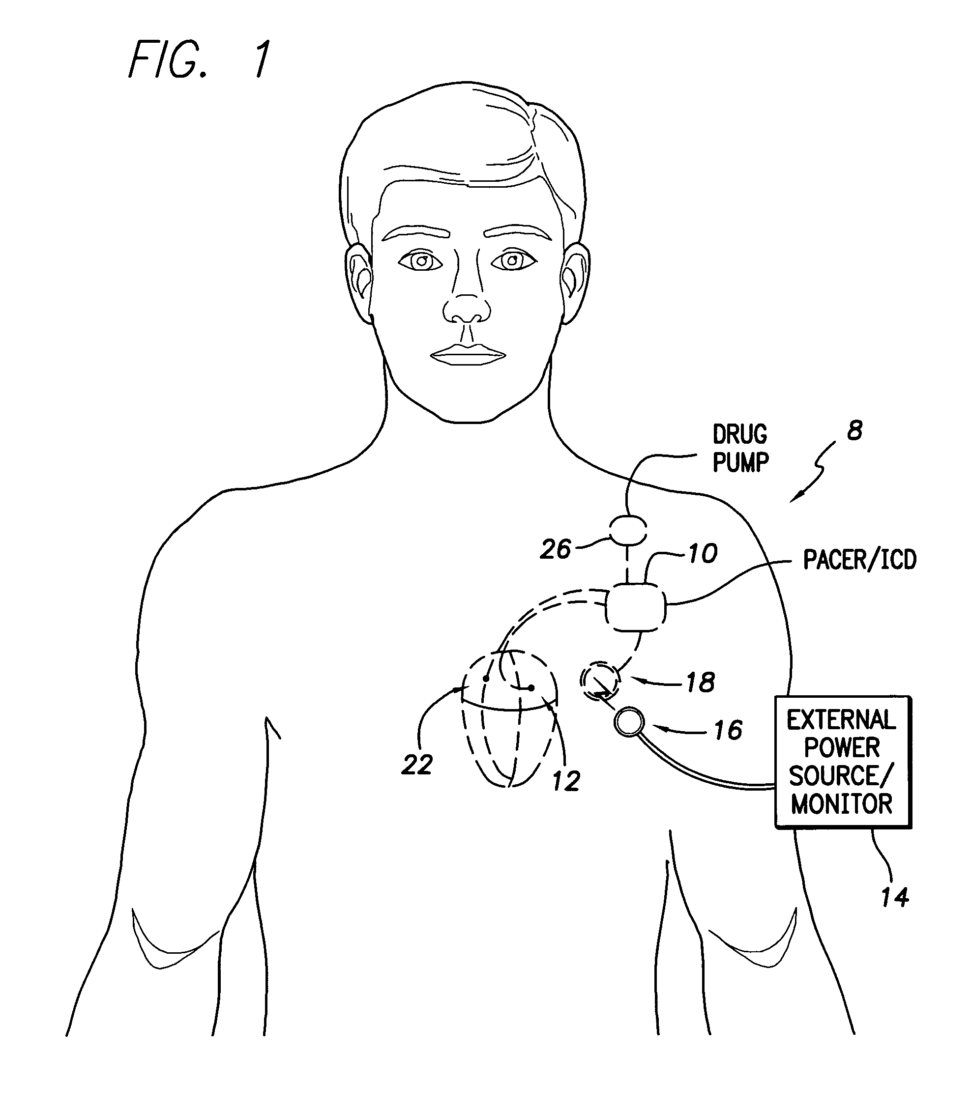 System and method for measuring cardiac output via thermal dilution using an implantable medical device with an external ultrasound power delivery system