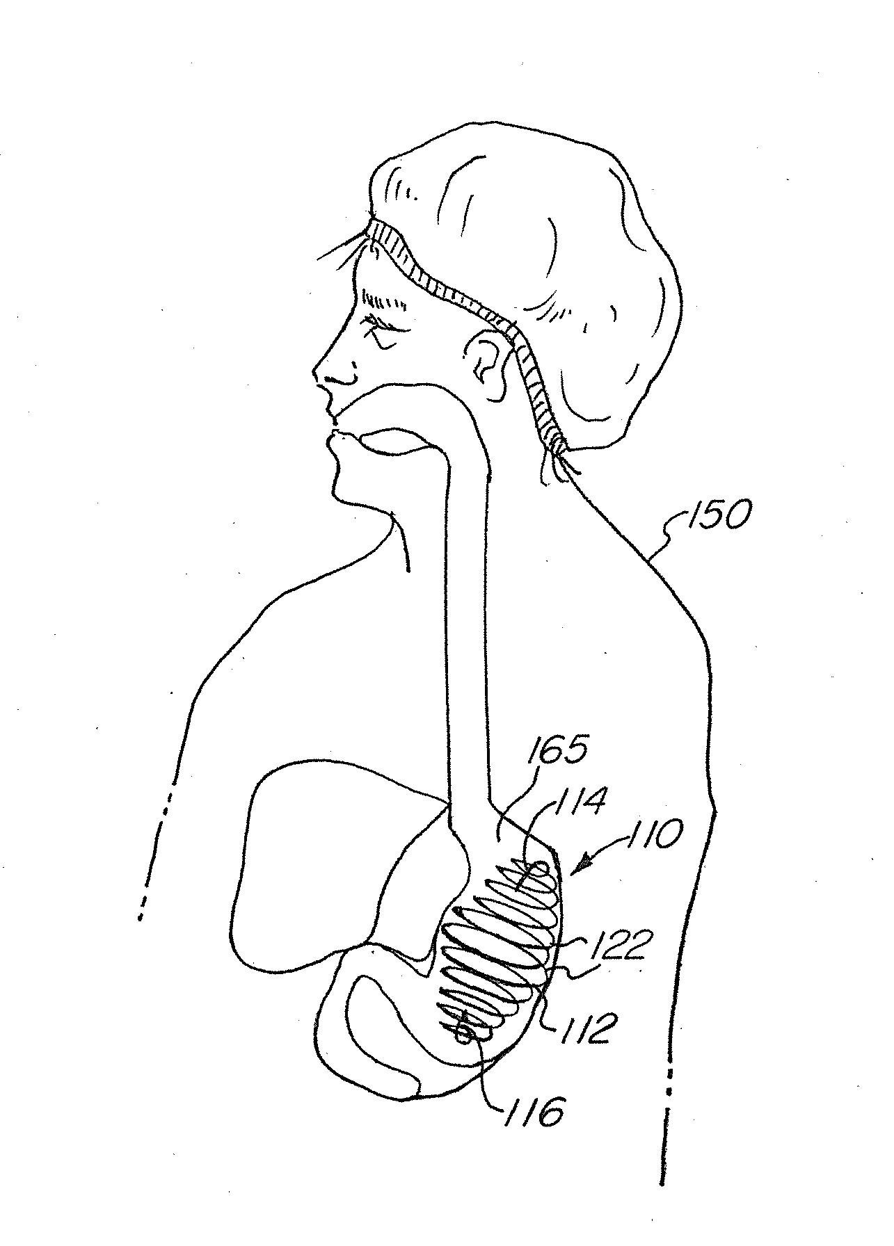 Flexible, self expansible, removable memory coil intragastric device and method of using such device for weight reduction and medication delivery