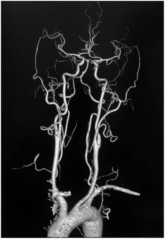 Head and neck angiography method