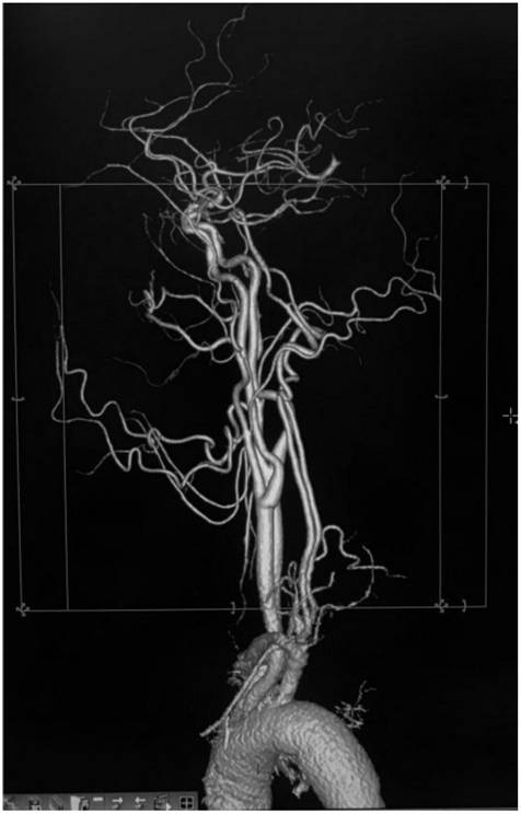 Head and neck angiography method