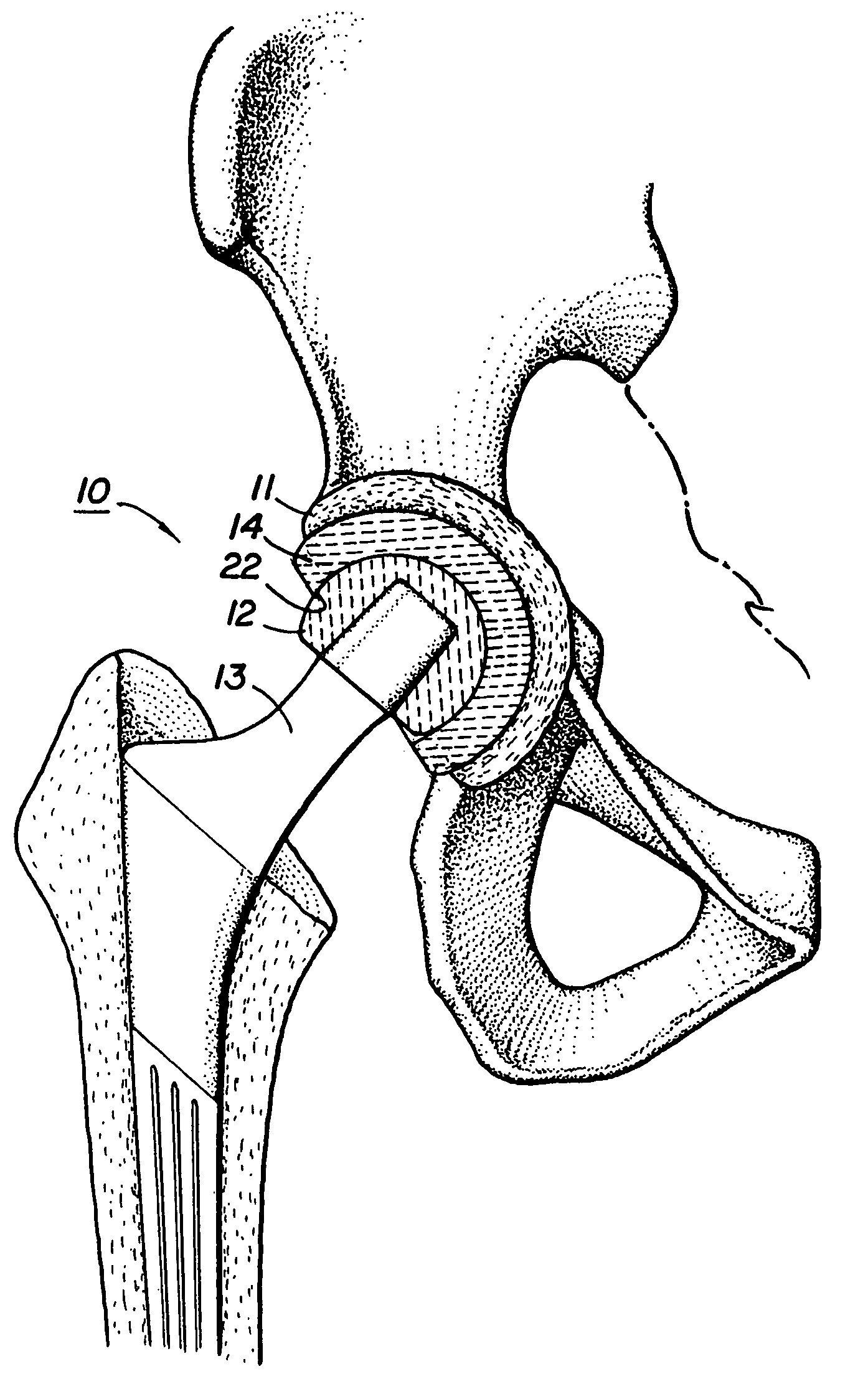 Containment system for constraining a prosthetic component