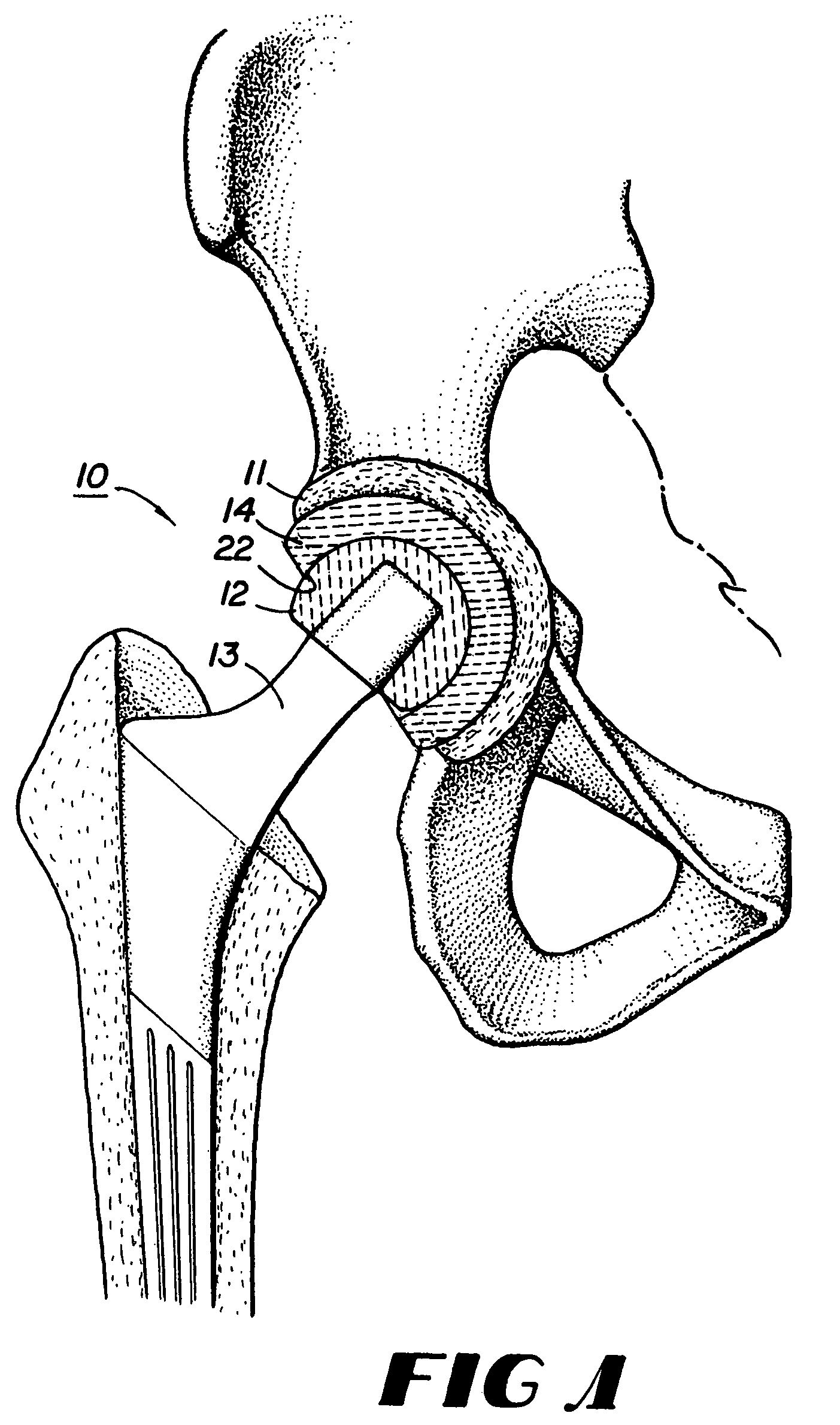 Containment system for constraining a prosthetic component