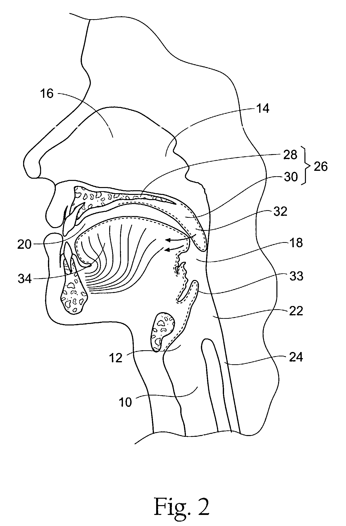 Systems and methods for moving and/or restraining tissue in the upper respiratory system